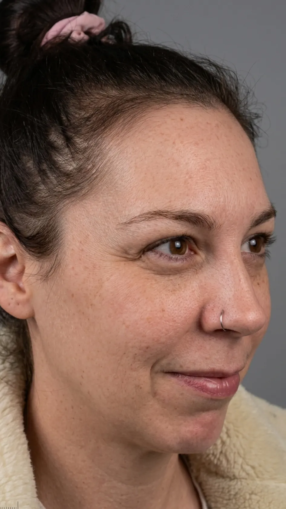 Before anti-wrinkle treatment at Dental & Wellness London, Islington