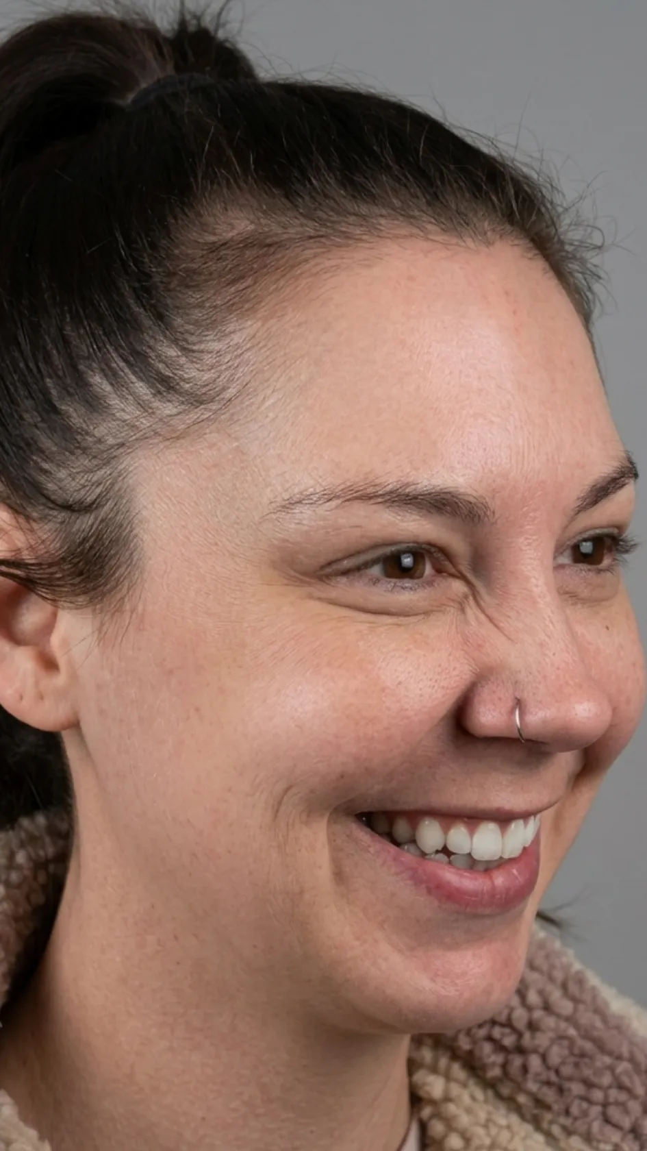 After anti-wrinkle treatment at Dental & Wellness London, Islington