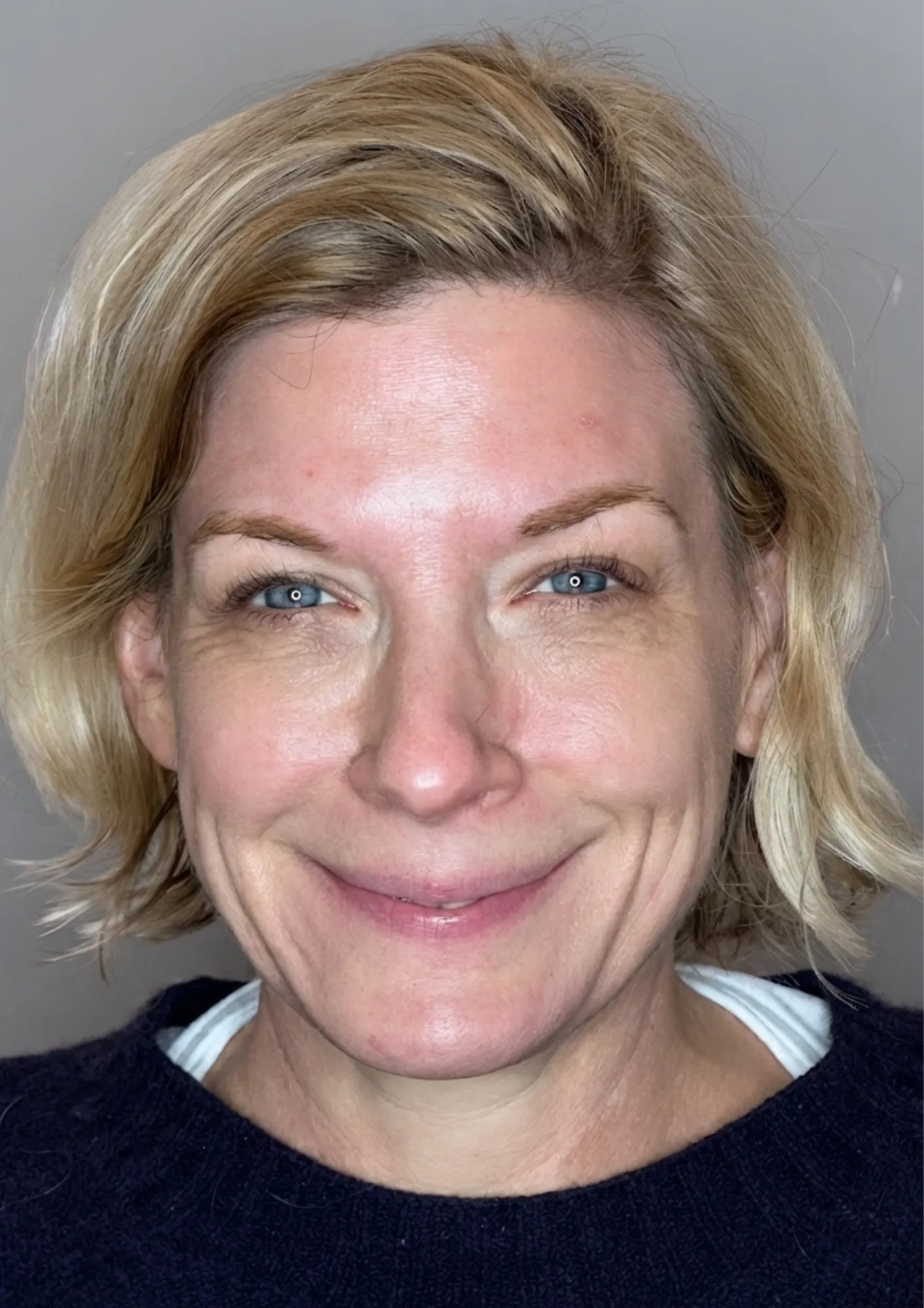 Before HydraFacial at Dental & Wellness London, Islington