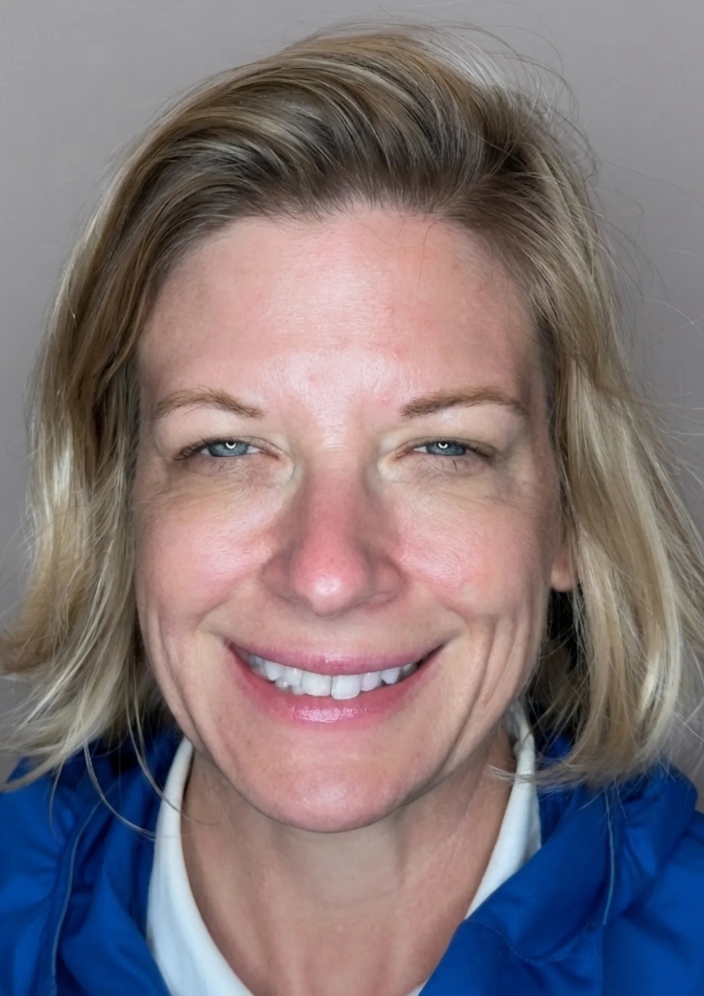 After HydraFacial at Dental & Wellness London, Islington