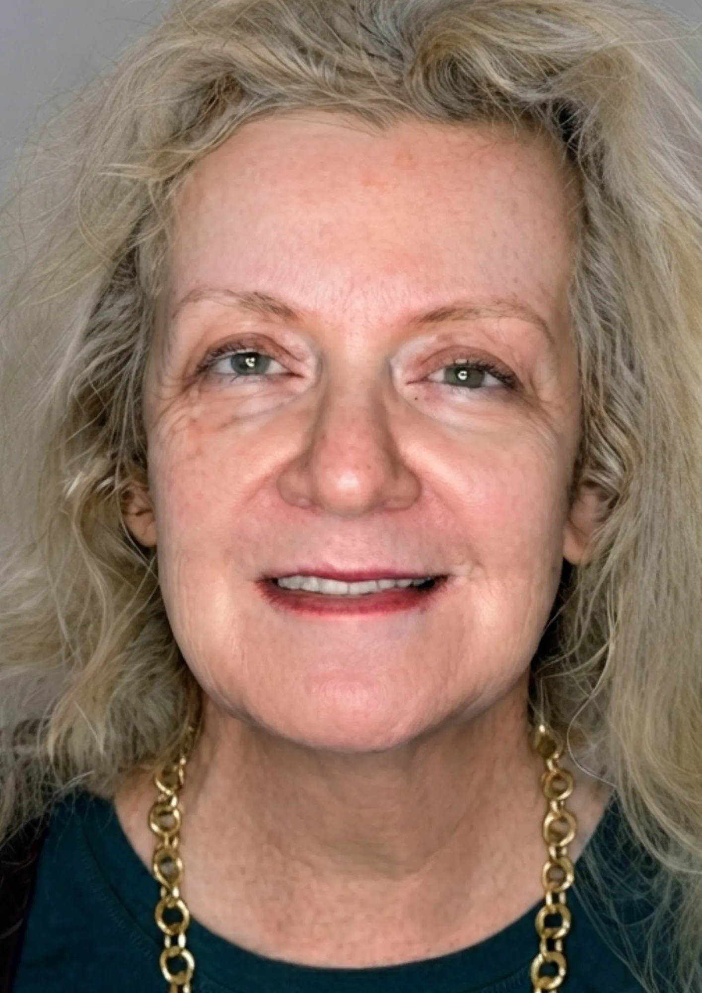 Before HydraFacial at Dental & Wellness London, Islington