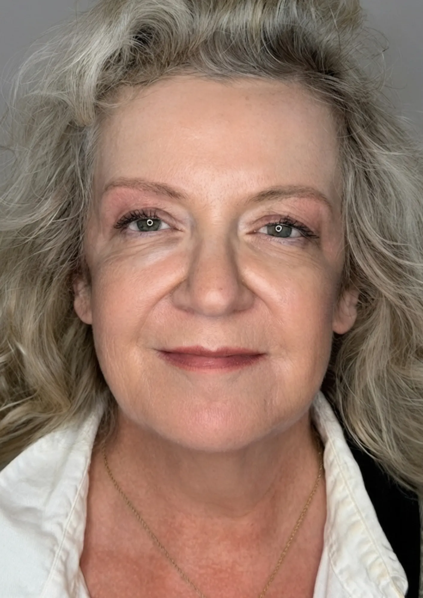 After HydraFacial at Dental & Wellness London, Islington