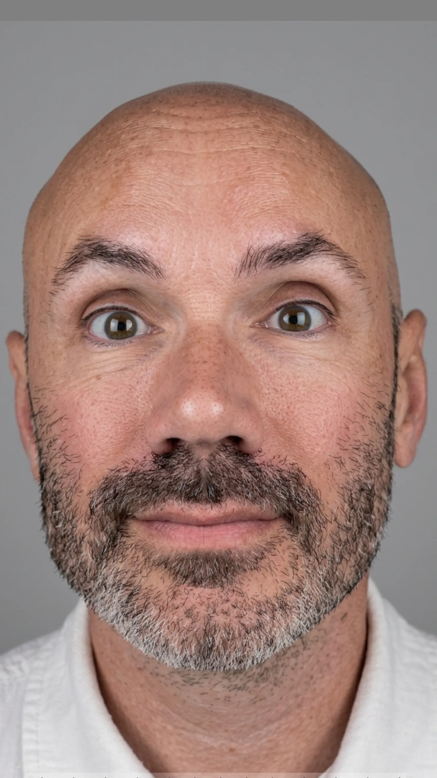 After anti-wrinkle treatment at Dental & Wellness London, Islington
