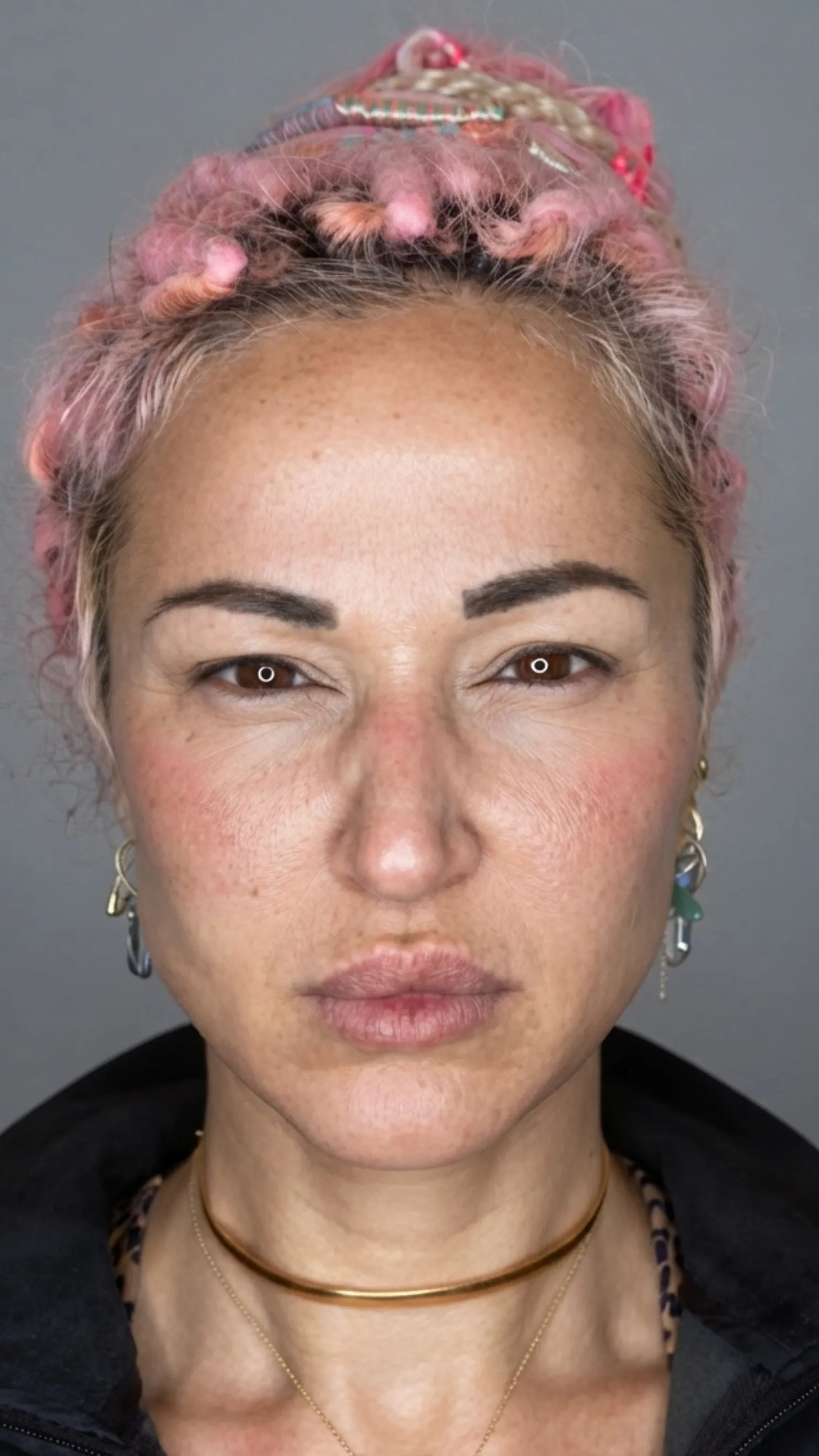 After anti-wrinkle treatment at Dental & Wellness London, Islington