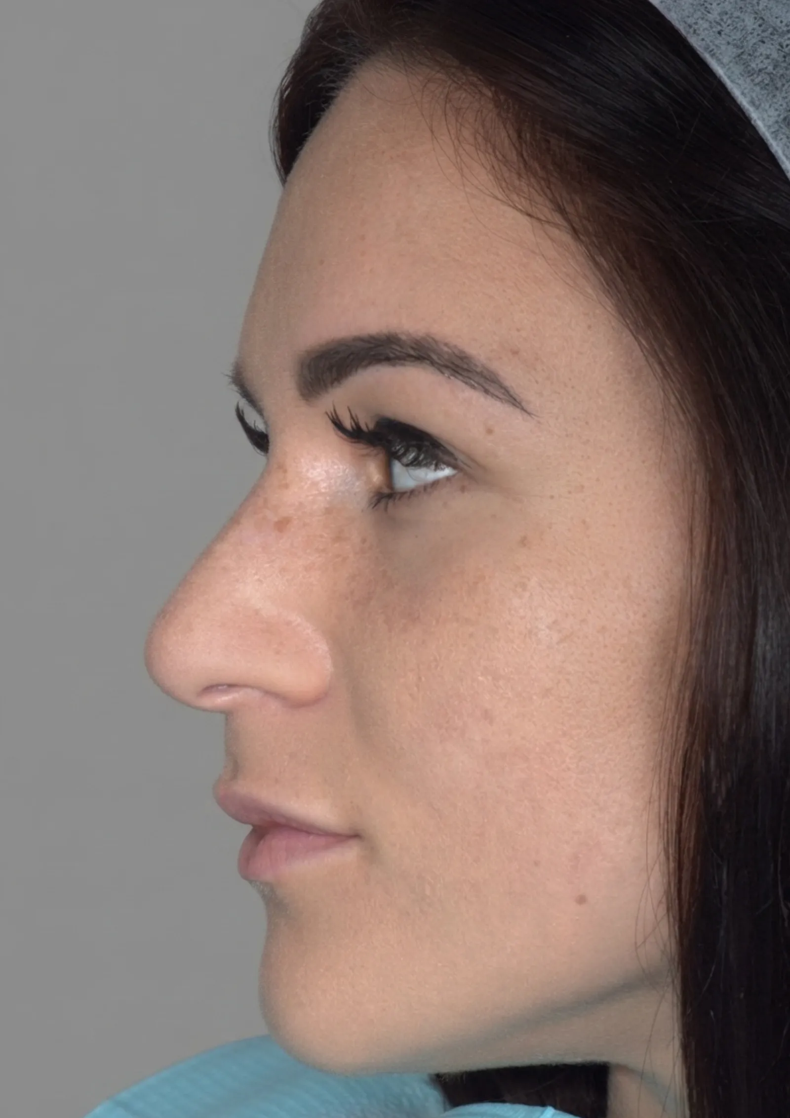 Before cheek filler at Dental & Wellness London, Islington