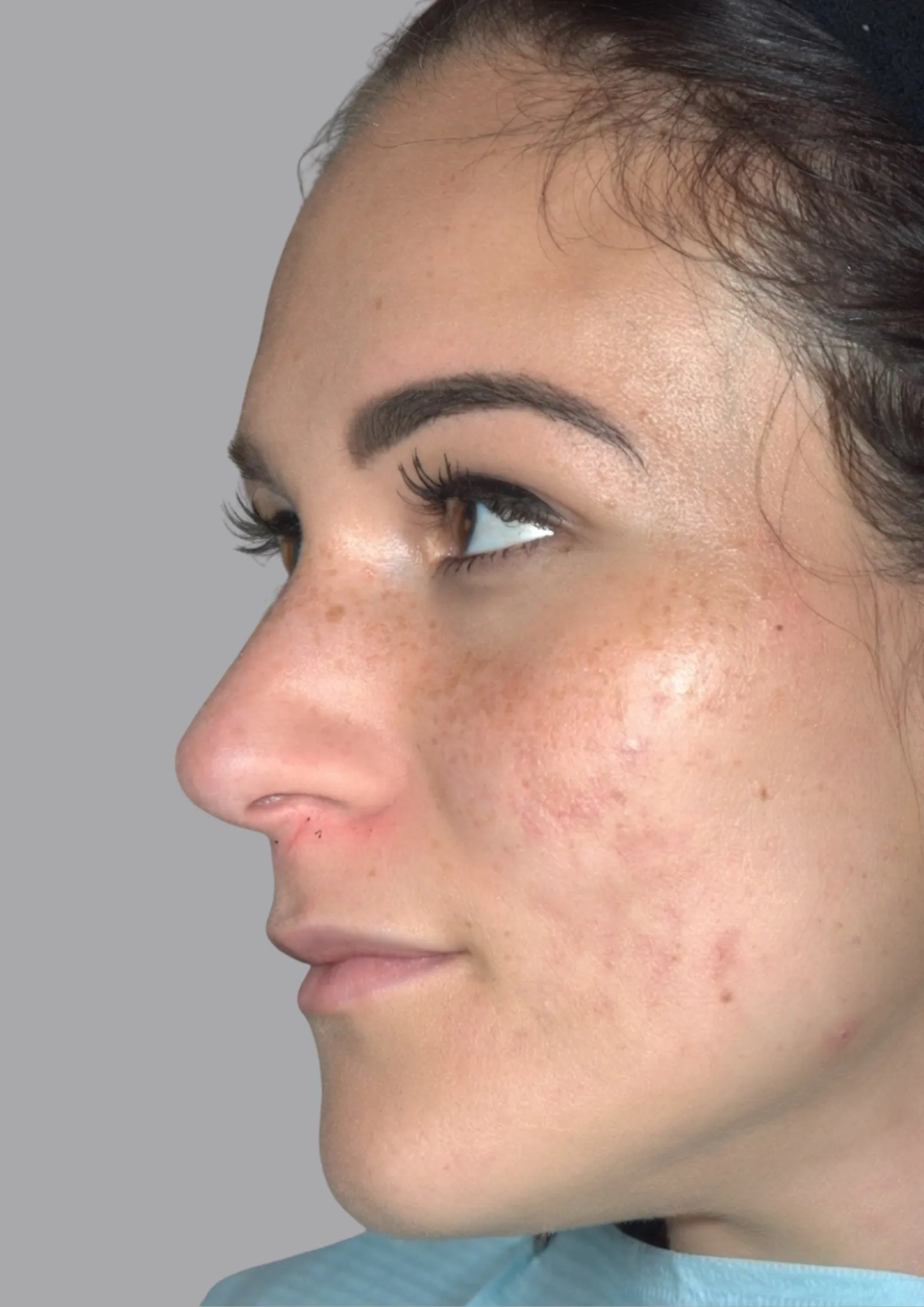 After cheek filler at Dental & Wellness London, Islington