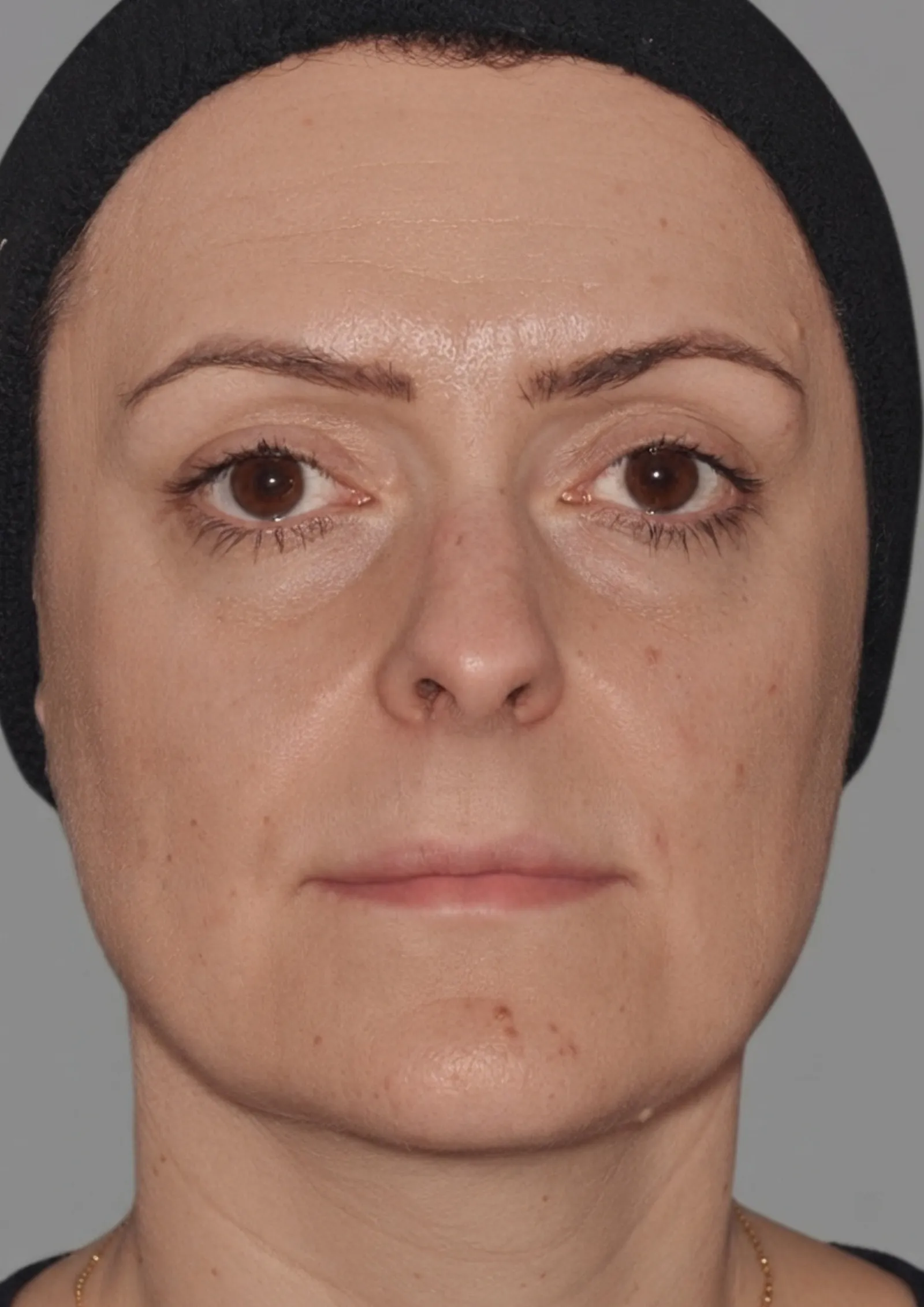 Before cheek filler at Dental & Wellness London, Islington