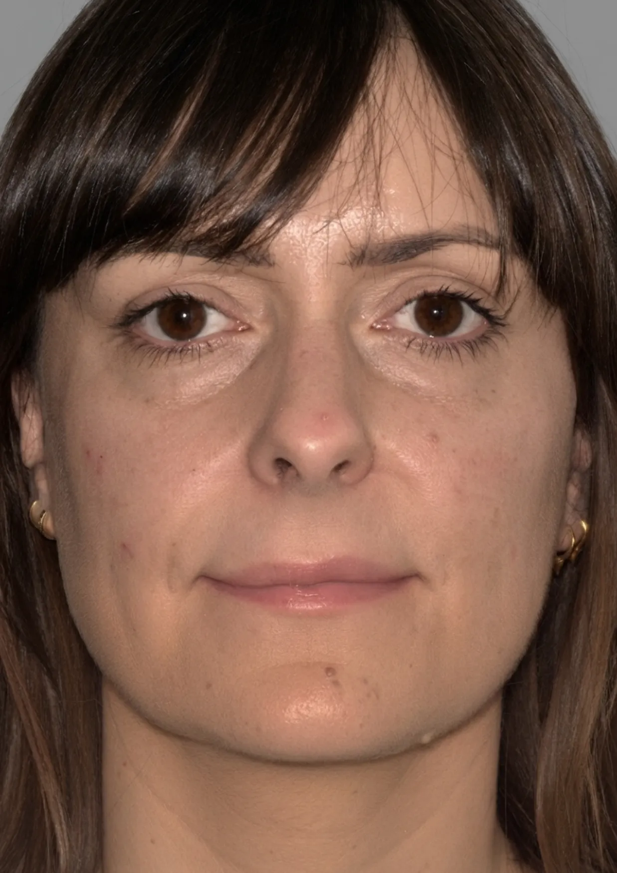 After cheek filler at Dental & Wellness London, Islington