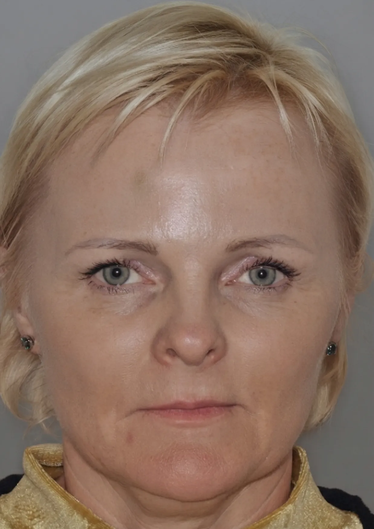 Before dermal filler at Dental & Wellness London, Islington