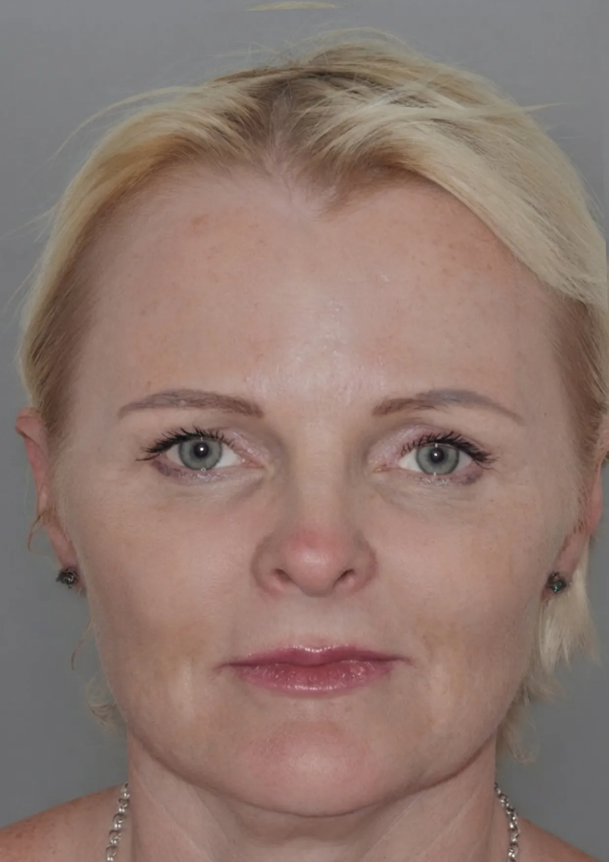 After dermal filler at Dental & Wellness London, Islington