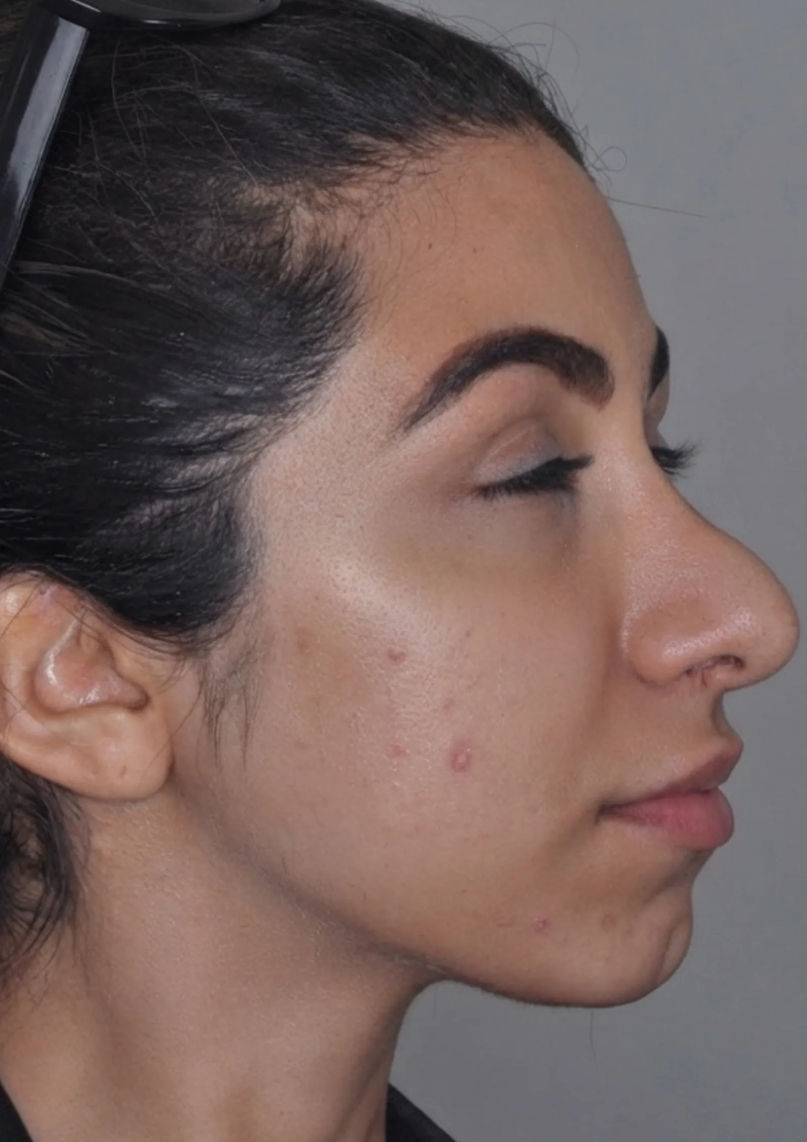 Before jawline filler at Dental & Wellness London, Islington