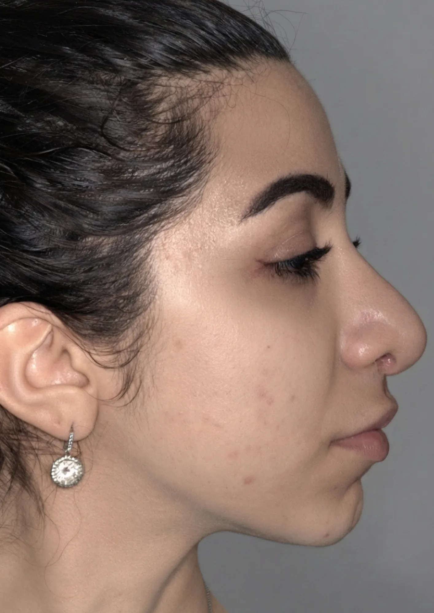 After jawline filler at Dental & Wellness London, Islington