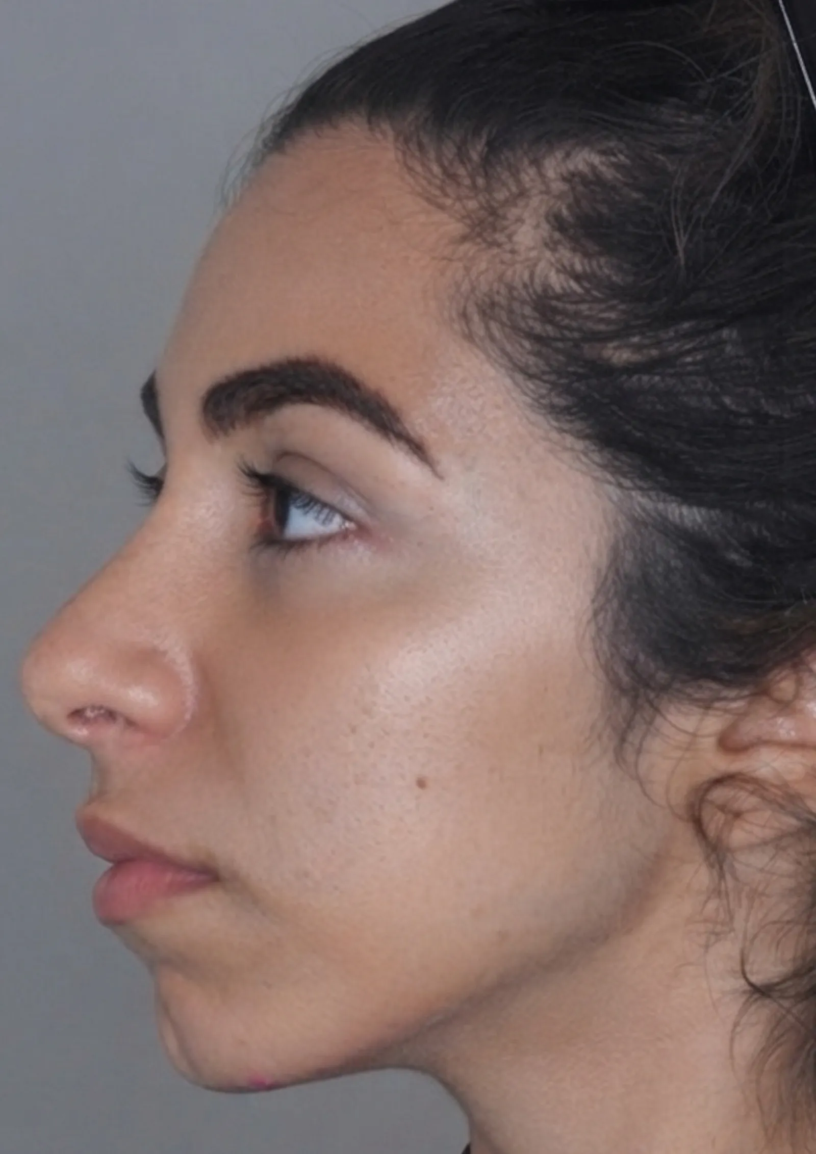 Before jawline filler at Dental & Wellness London, Islington