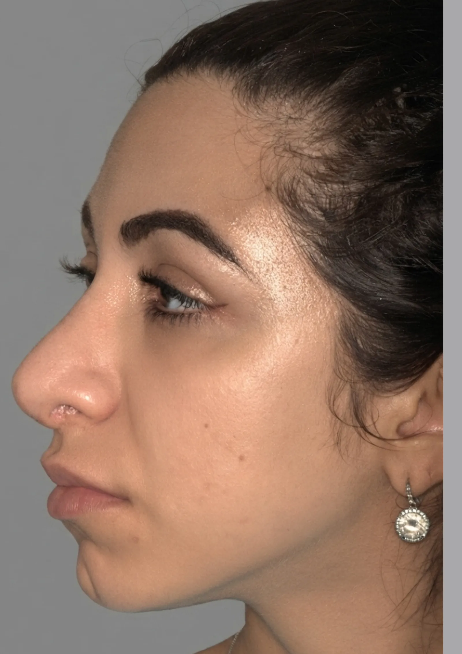 After jawline filler at Dental & Wellness London, Islington