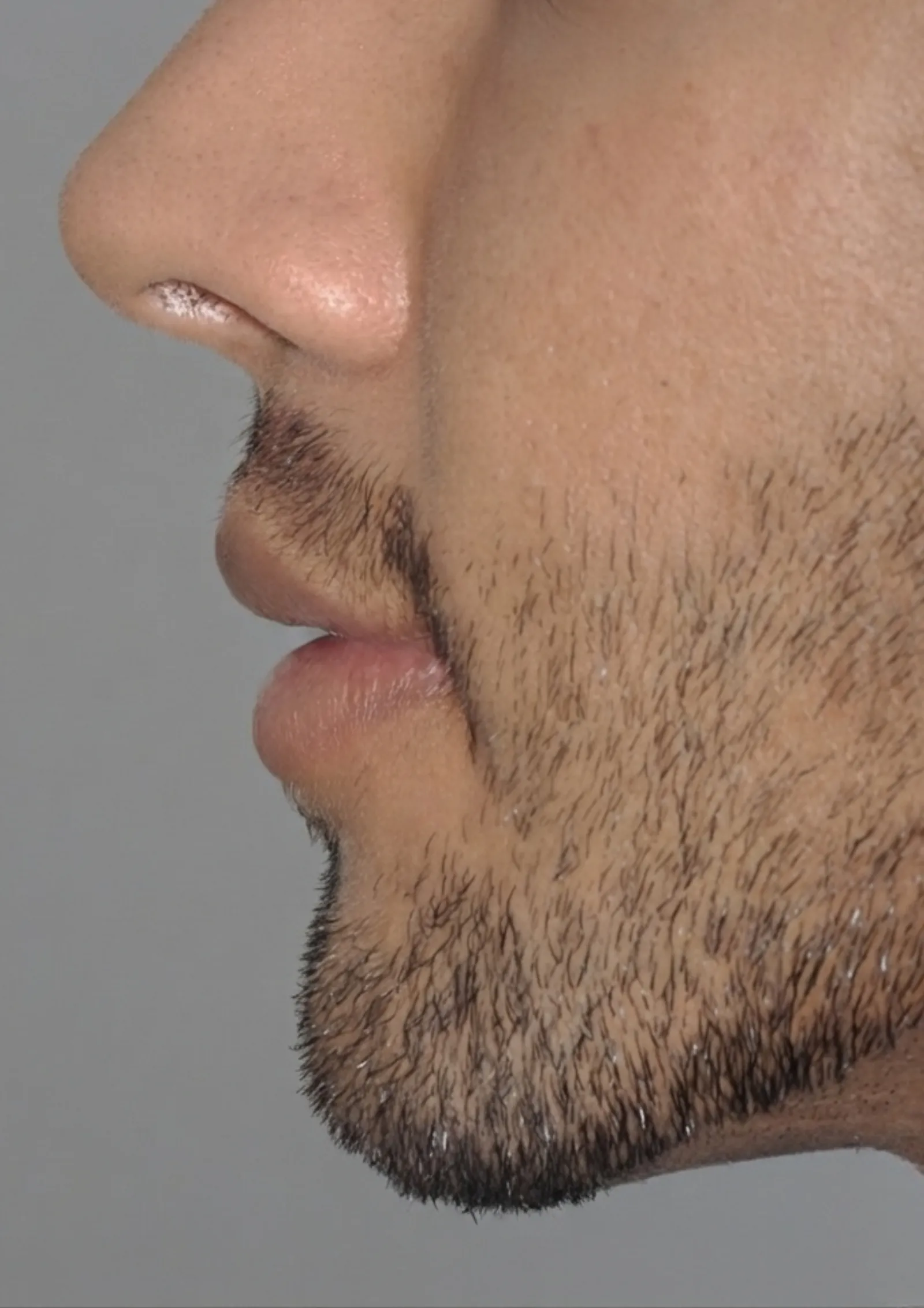 Before lip flip at Dental & Wellness London, Islington
