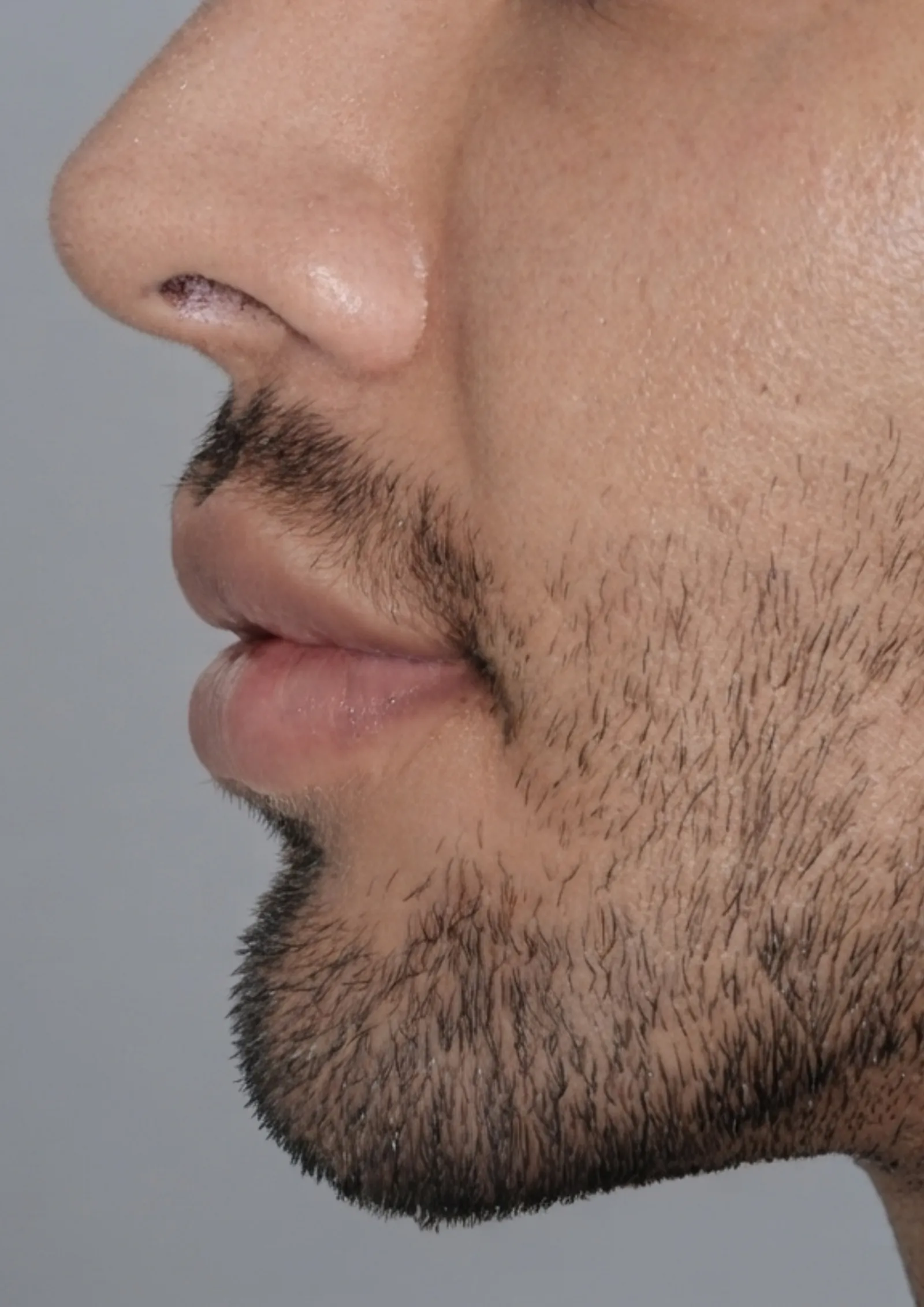 After lip flip at Dental & Wellness London, Islington
