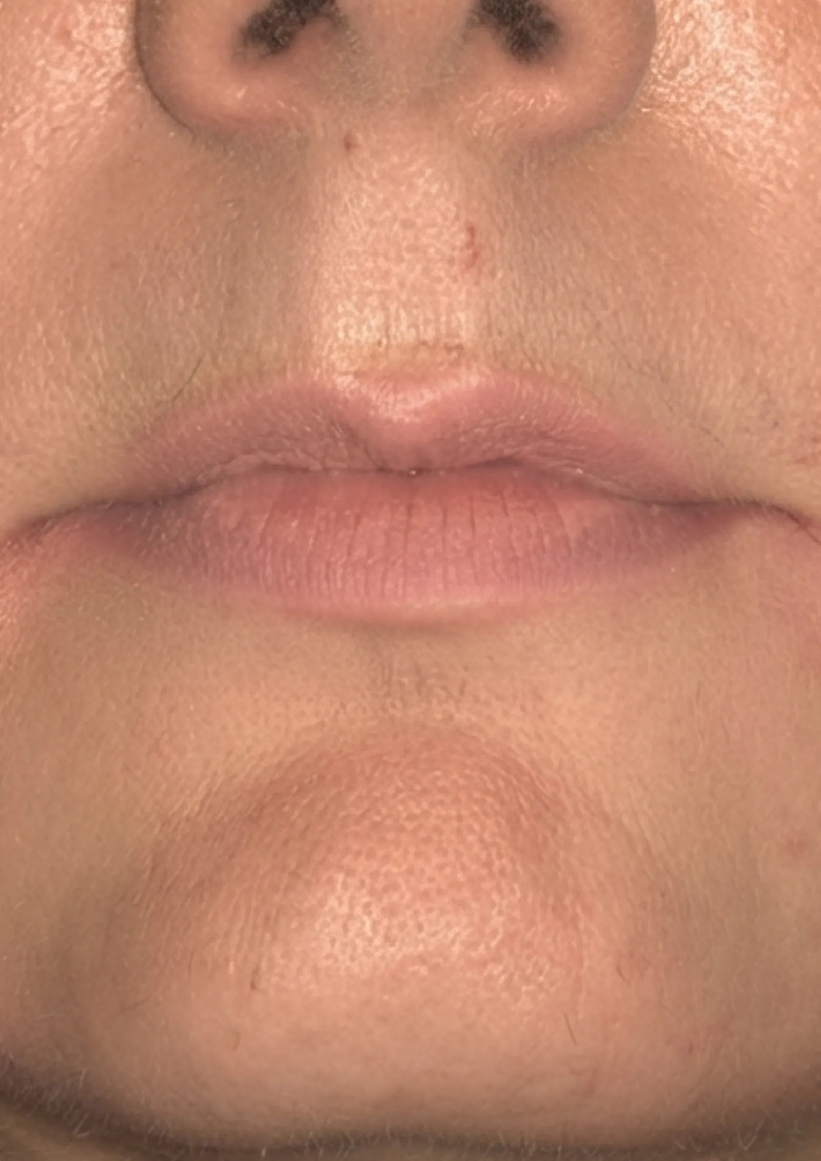 Before lip flip at Dental & Wellness London, Islington