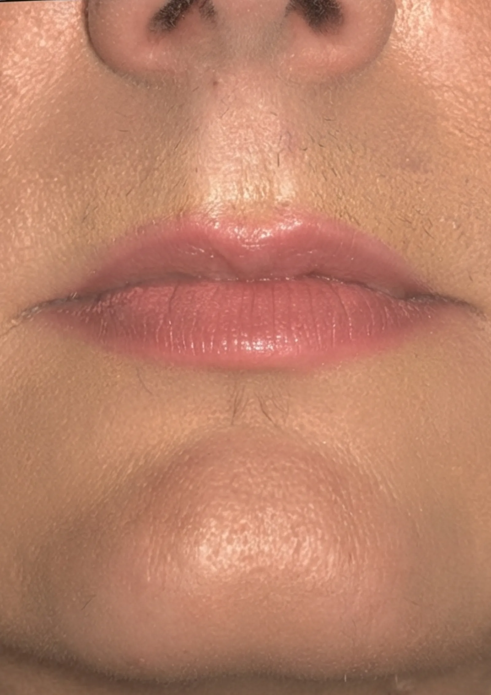After lip flip at Dental & Wellness London, Islington