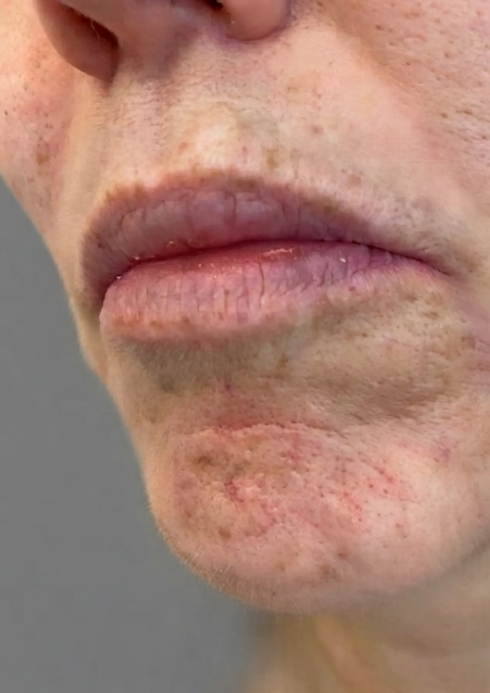 Before lip flip at Dental & Wellness London, Islington