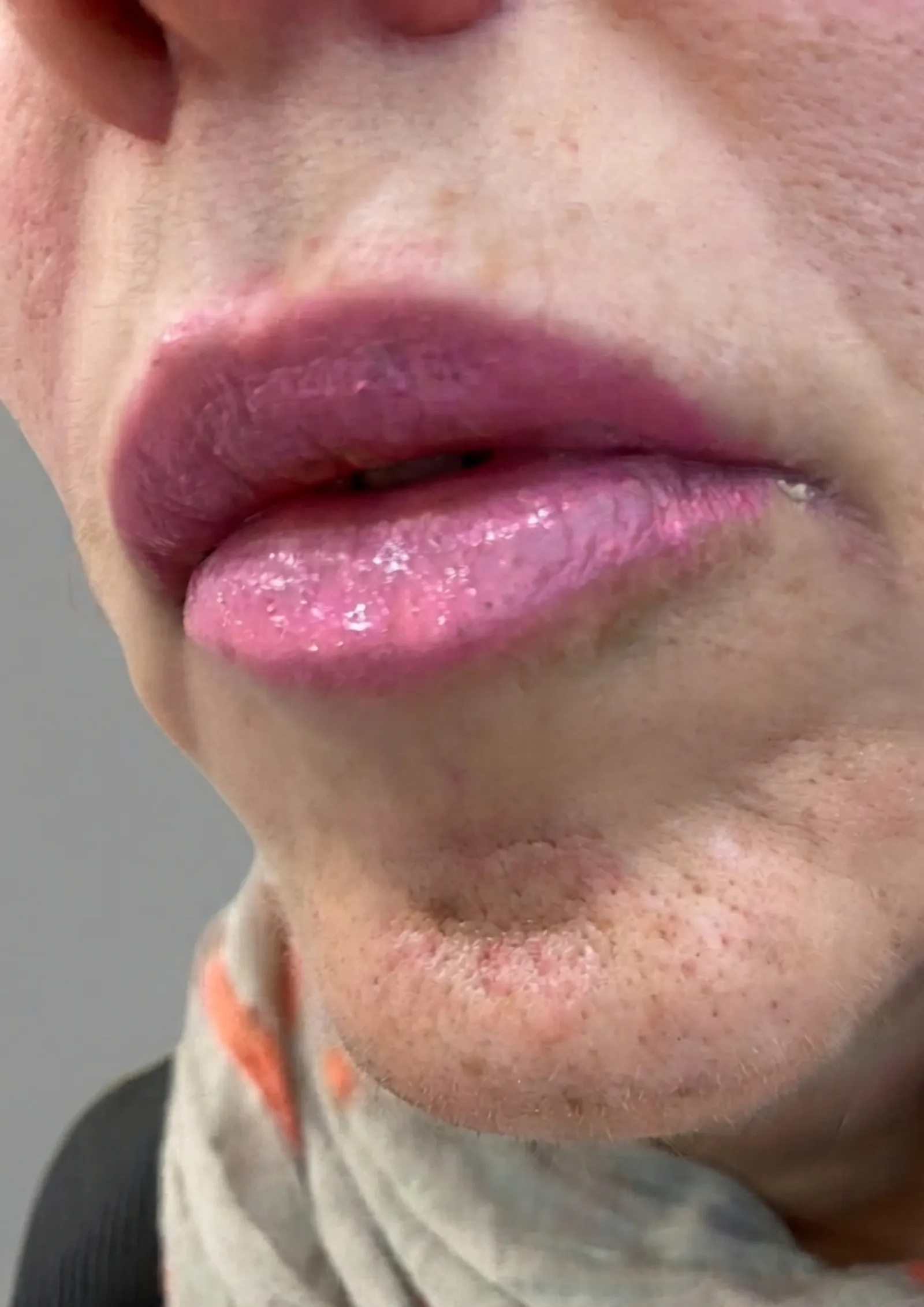 After lip flip at Dental & Wellness London, Islington
