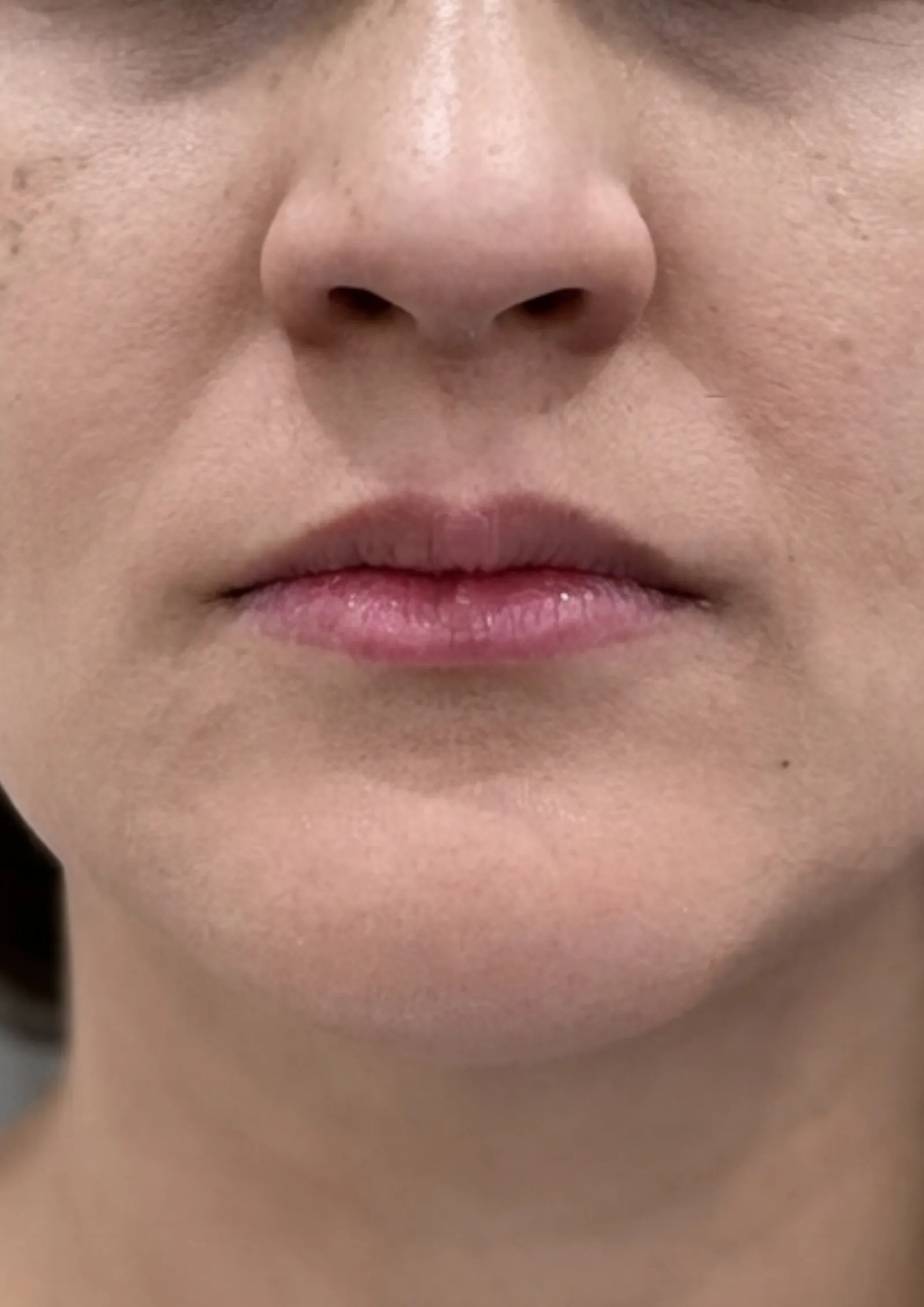 Before lip flip at Dental & Wellness London, Islington
