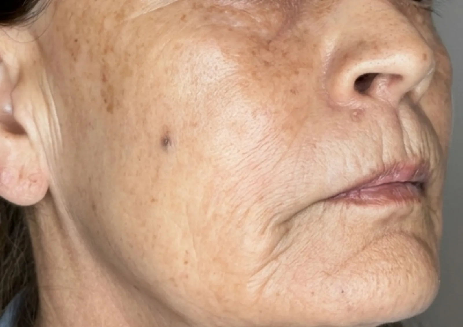 Before polynucleotide treatment at Dental & Wellness London, Islington