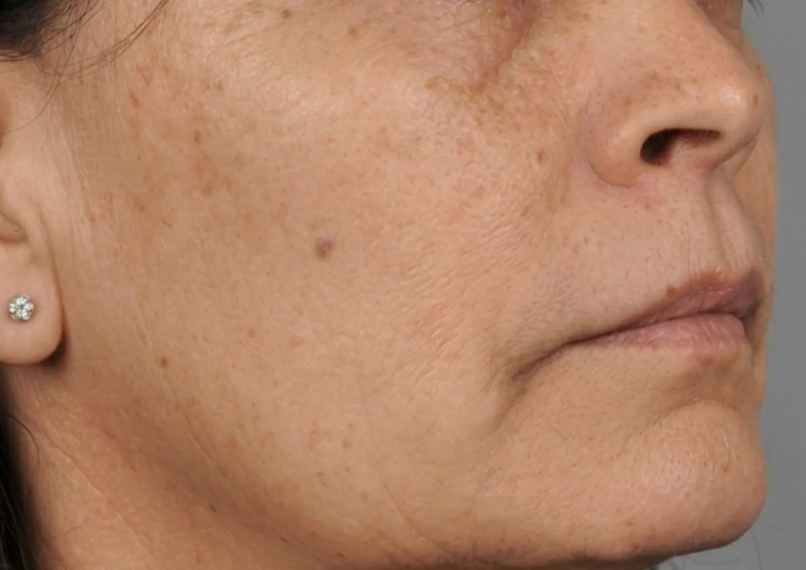 After polynucleotide treatment at Dental & Wellness London, Islington