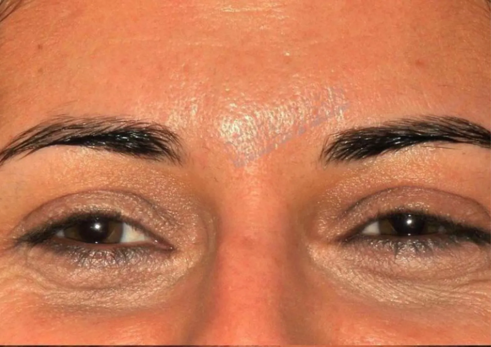 Before polynucleotide treatment at Dental & Wellness London, Islington
