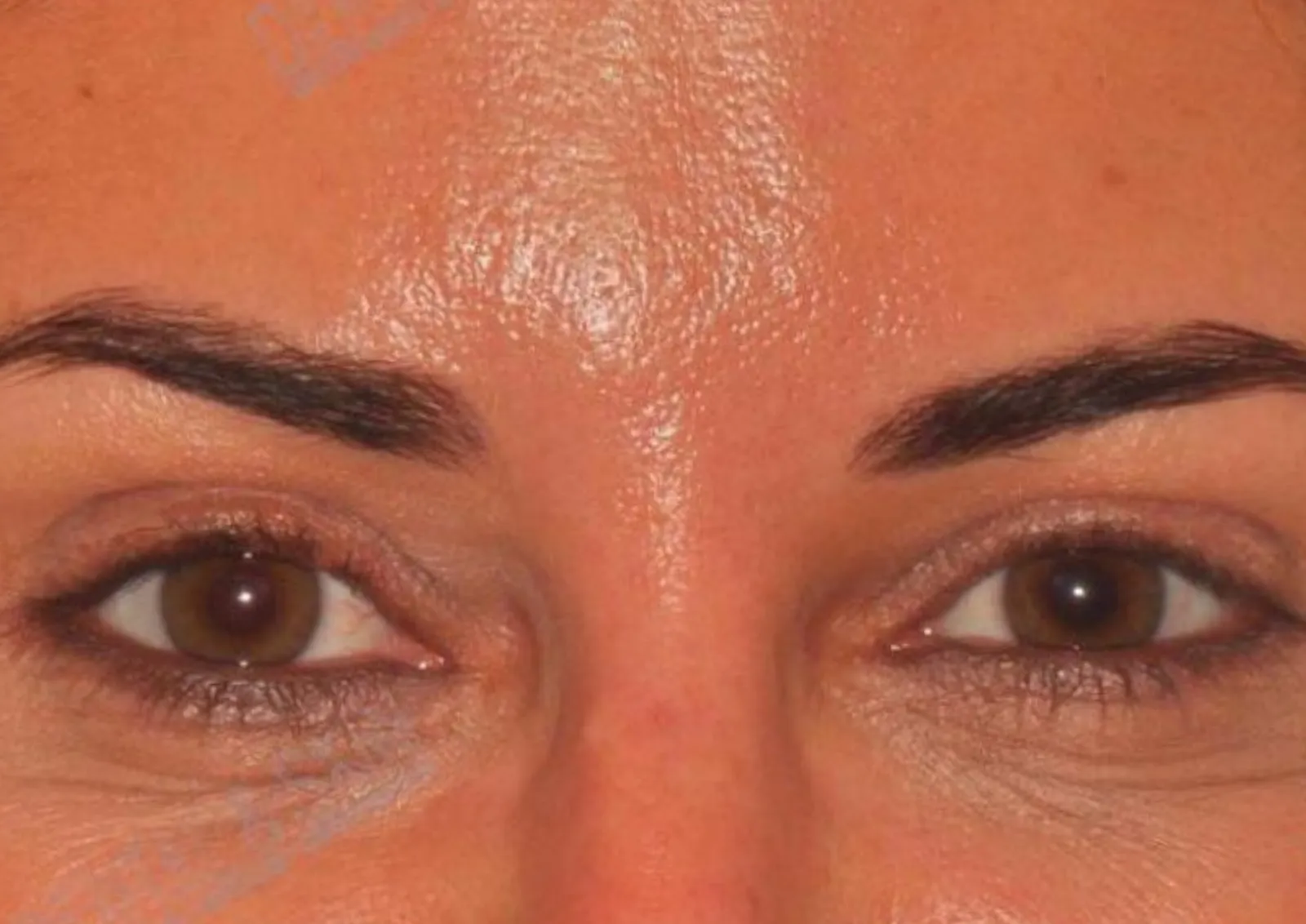 After polynucleotide treatment at Dental & Wellness London, Islington