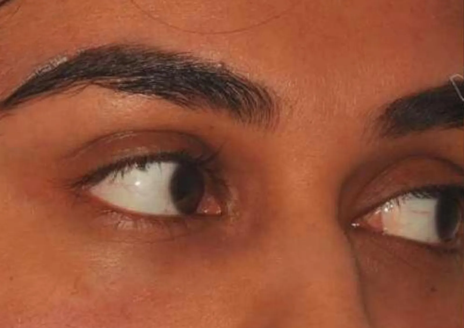After under-eye polynucleotide treatment at Dental & Wellness London, Islington