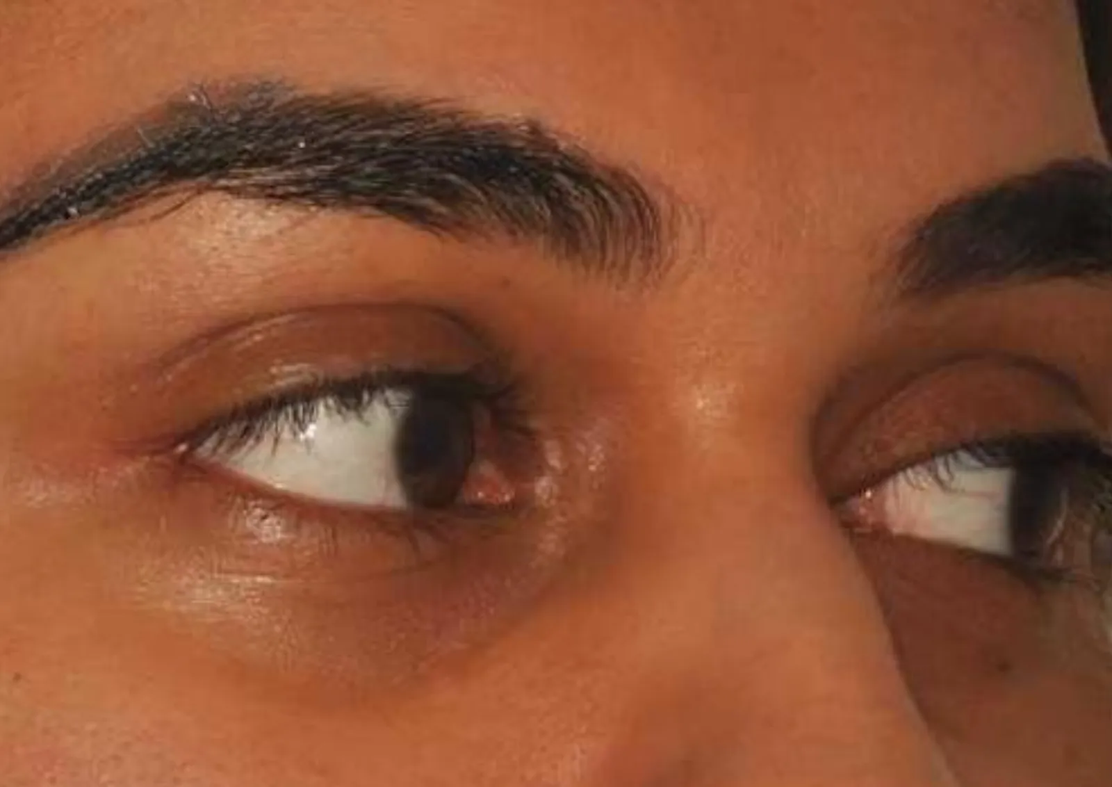 Before under-eye polynucleotide treatment at Dental & Wellness London, Islington