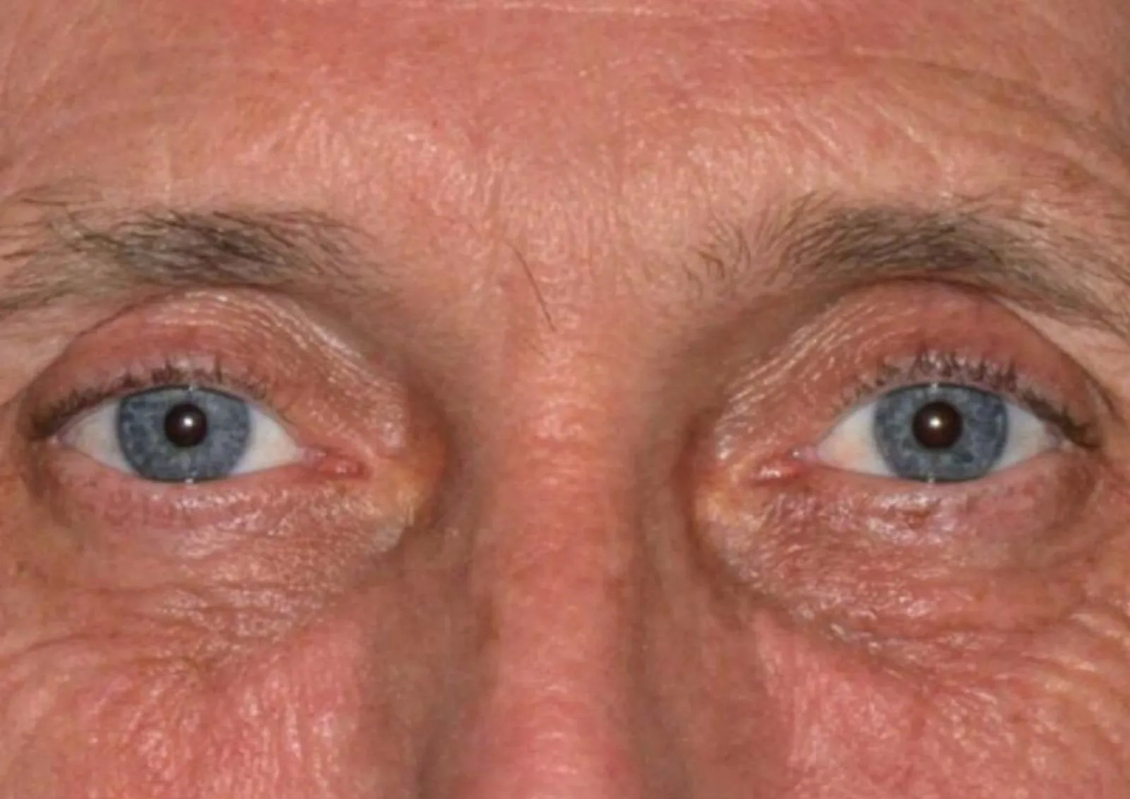 Before polynucleotide treatment at Dental & Wellness London, Islington