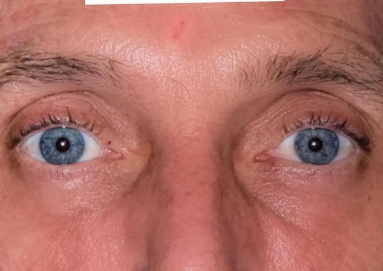 After polynucleotide treatment at Dental & Wellness London, Islington