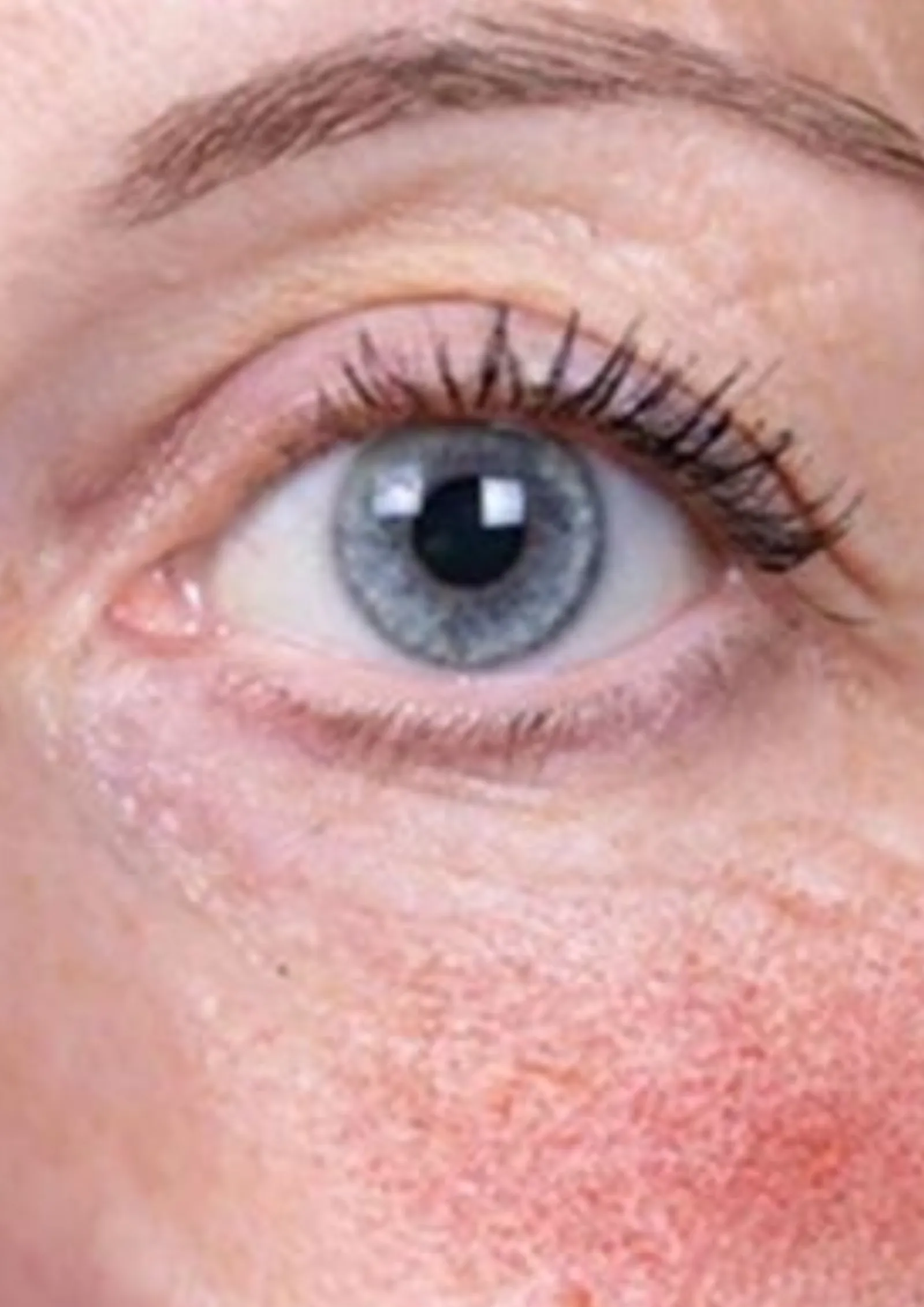Before skin booster treatment at Dental & Wellness London, Islington