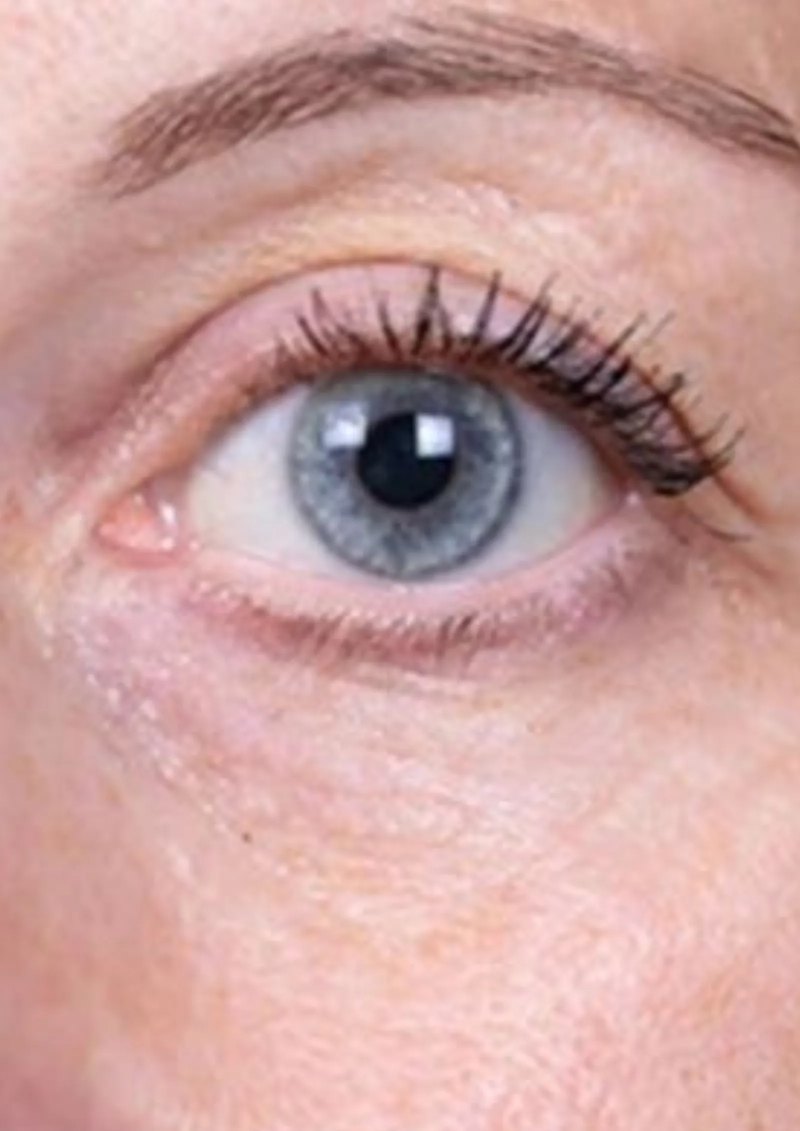 After skin booster treatment at Dental & Wellness London, Islington