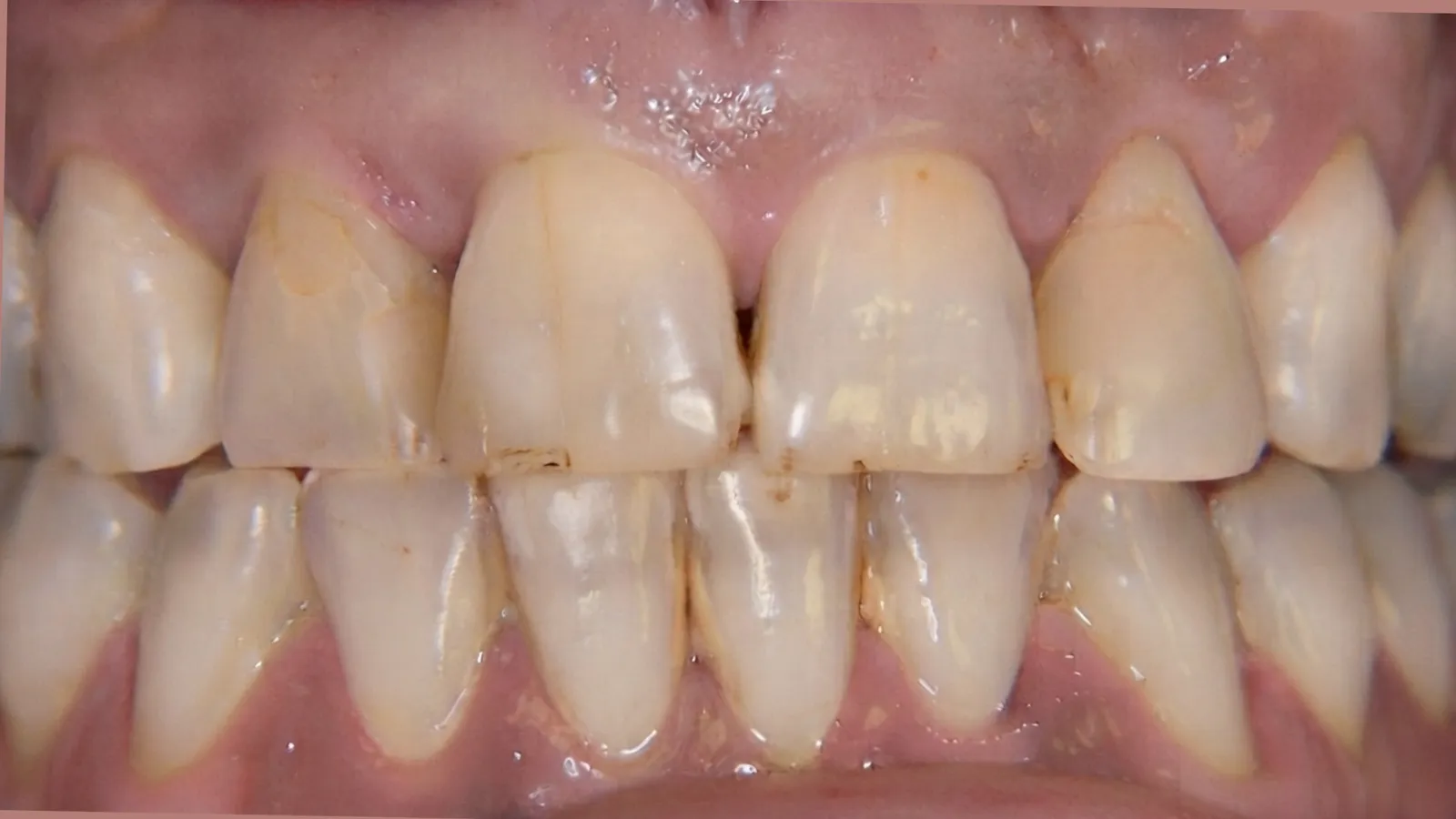 Before smile makeover at Dental & Wellness London, Islington