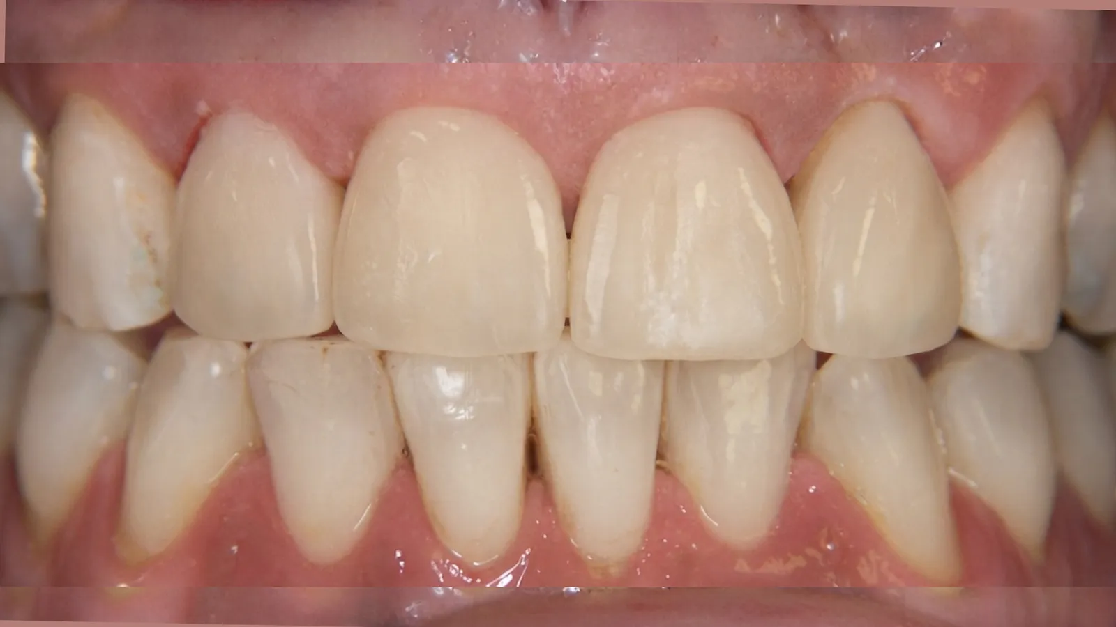 After smile makeover at Dental & Wellness London, Islington