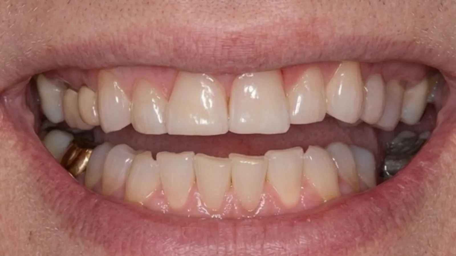 After smile makeover at Dental & Wellness London, Islington
