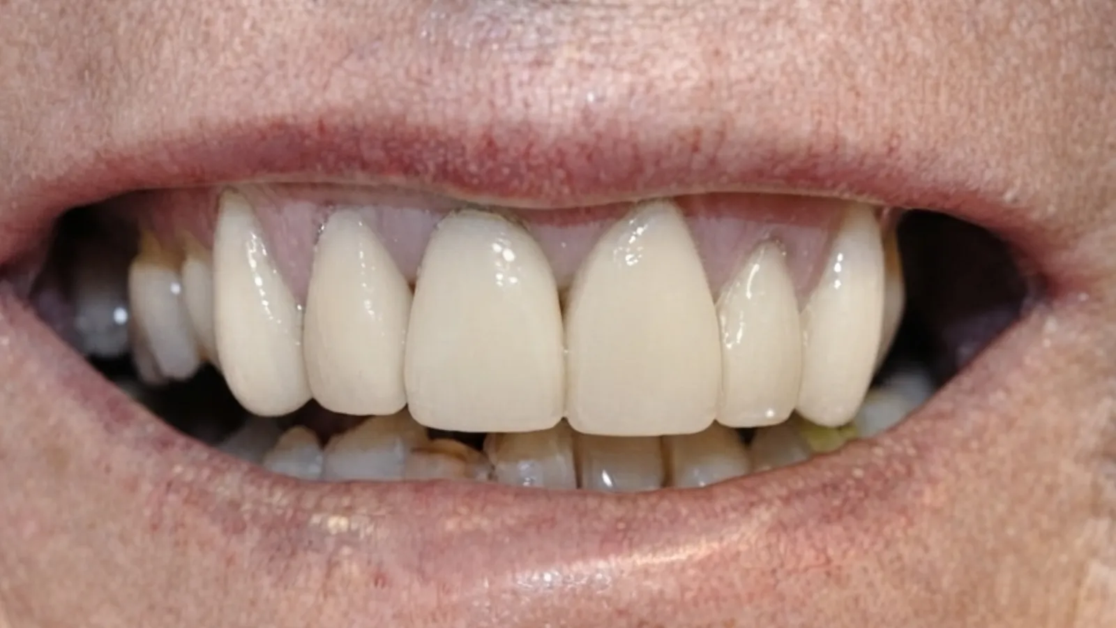 After smile makeover at Dental & Wellness London, Islington