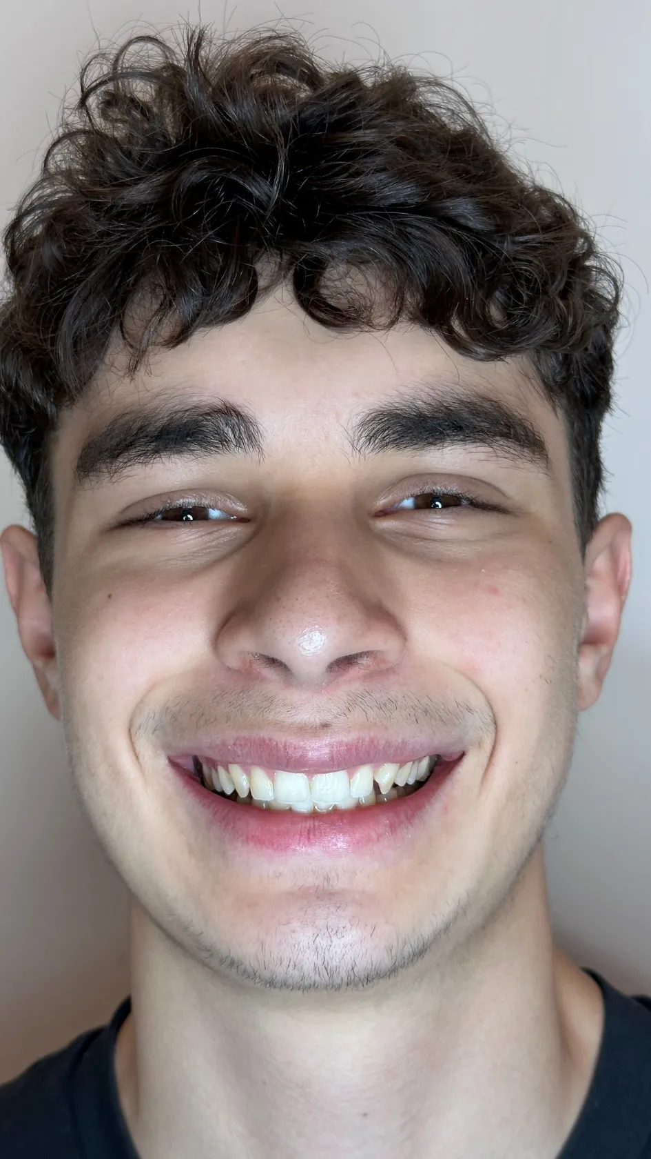 Before Invisalign at Dental & Wellness London, Islington