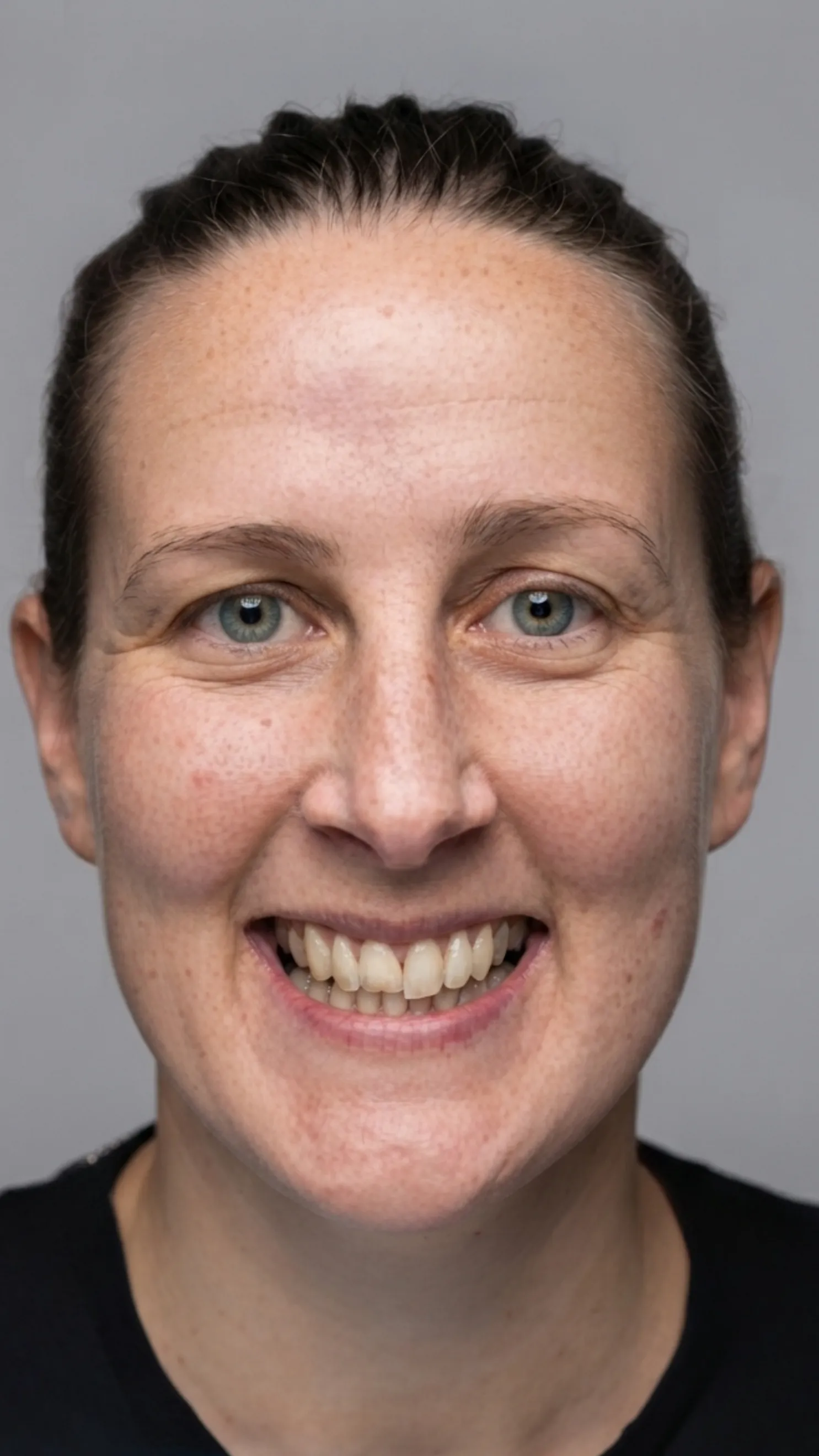 Before Invisalign at Dental & Wellness London, Islington