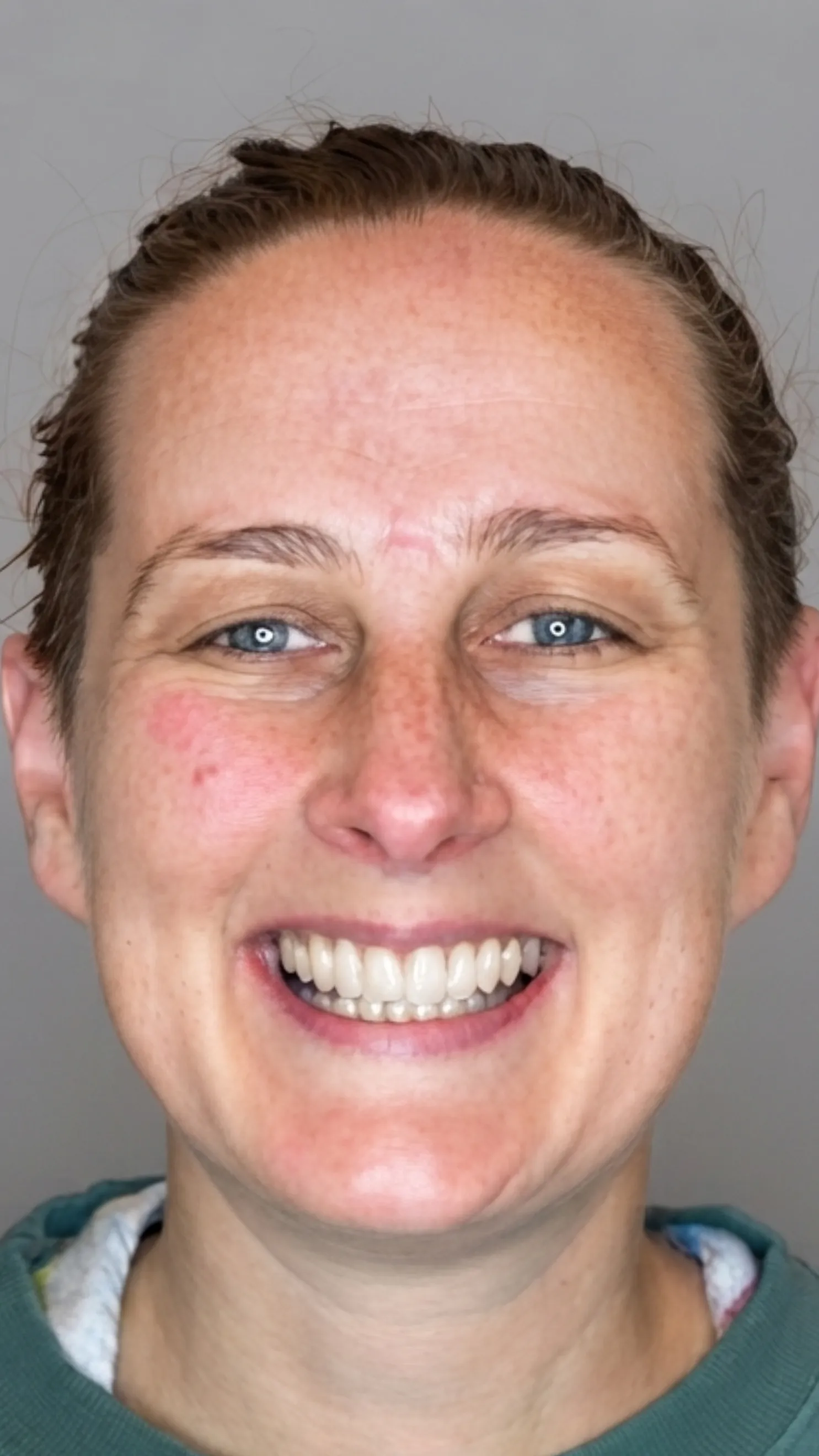 After Invisalign at Dental & Wellness London, Islington