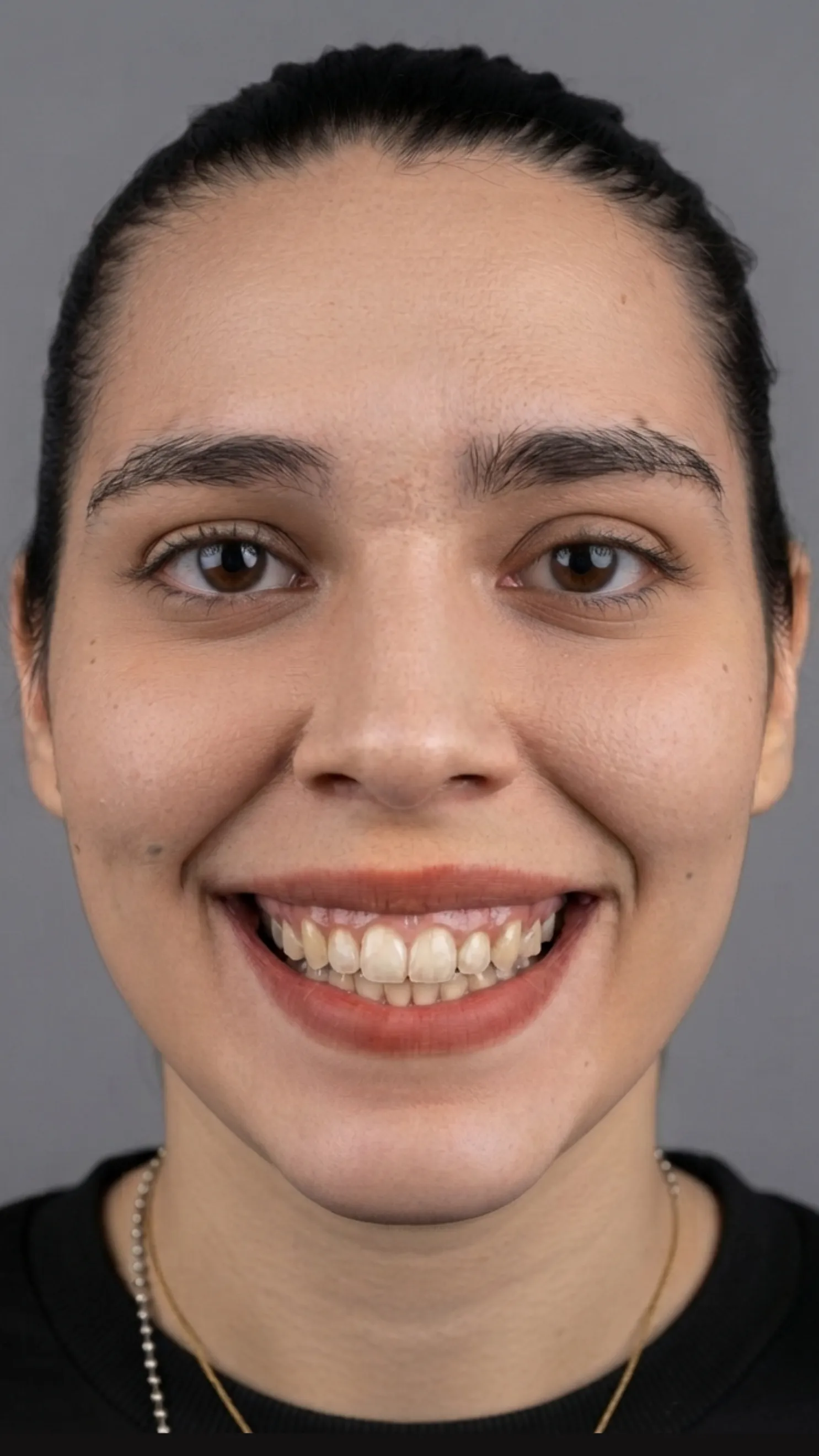After Invisalign at Dental & Wellness London, Islington