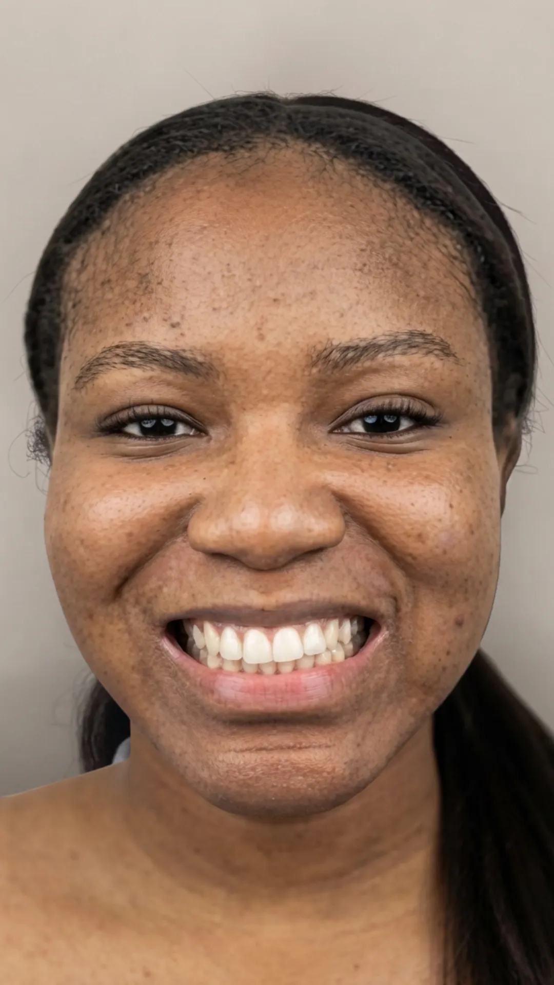 Before Invisalign at Dental & Wellness London, Islington