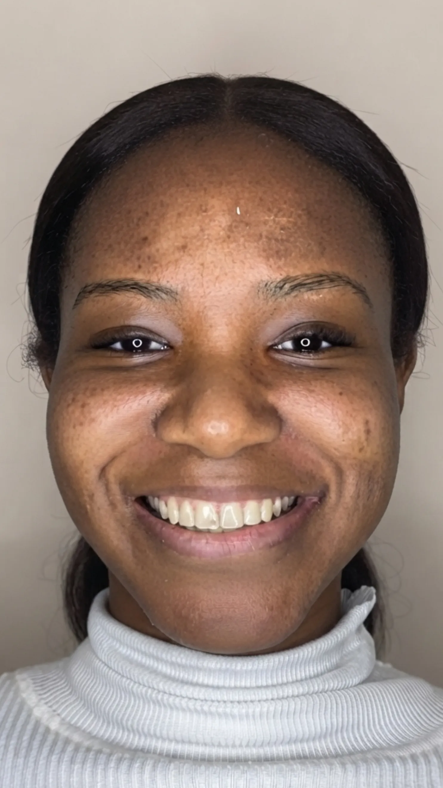 After Invisalign at Dental & Wellness London, Islington