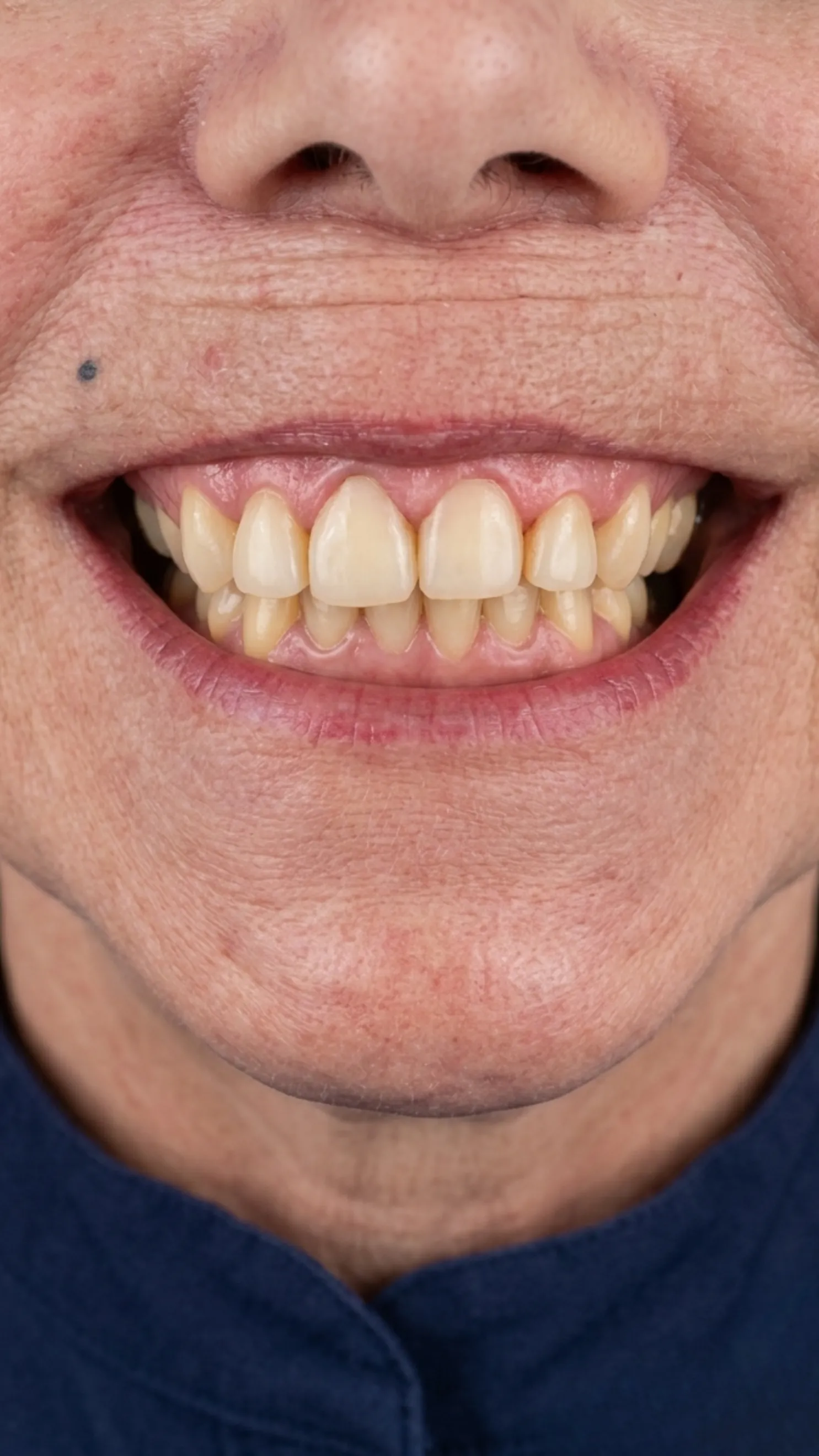 After composite bonding at Dental & Wellness London, Islington