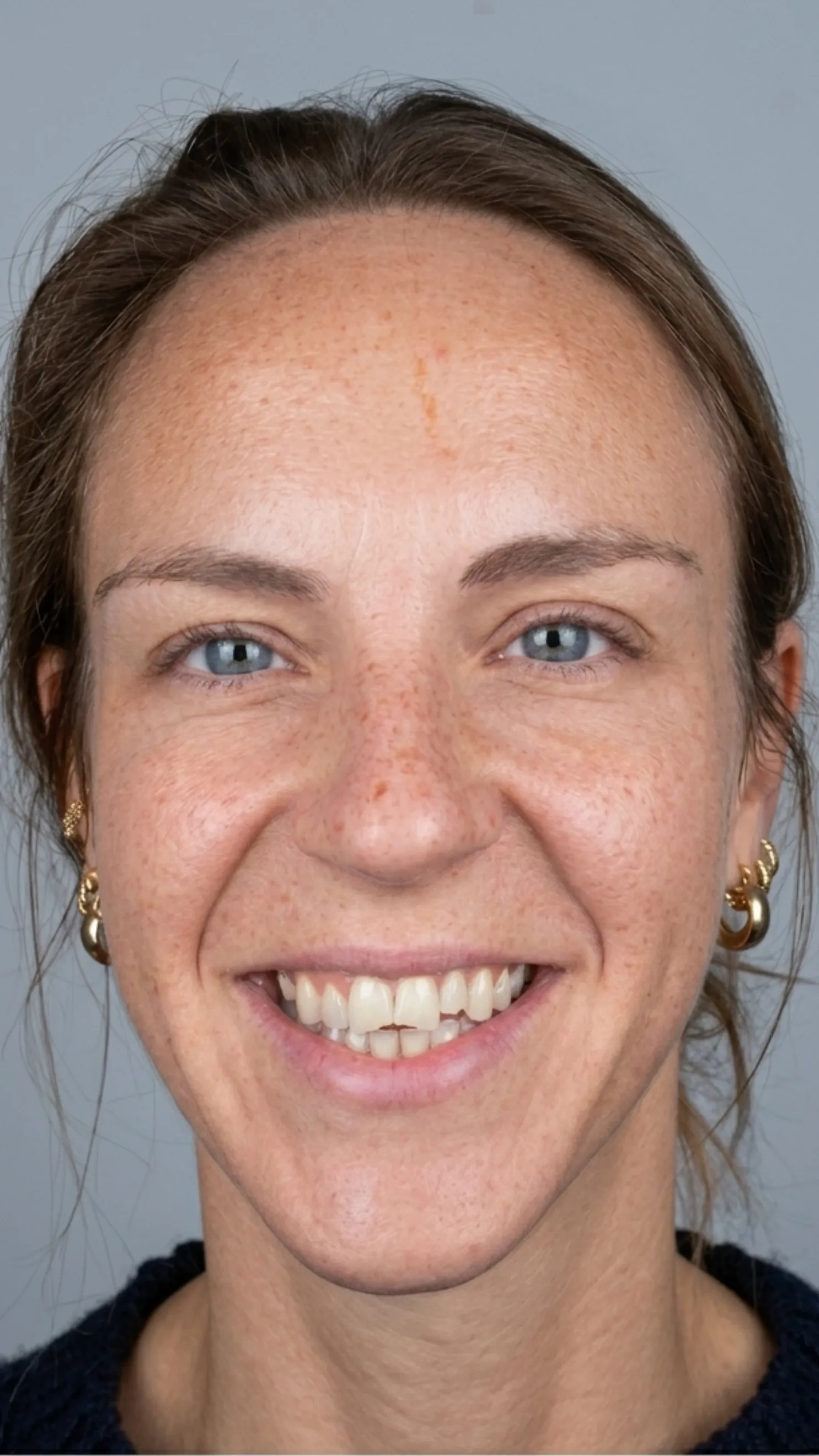 Before composite bonding at Dental & Wellness London, Islington