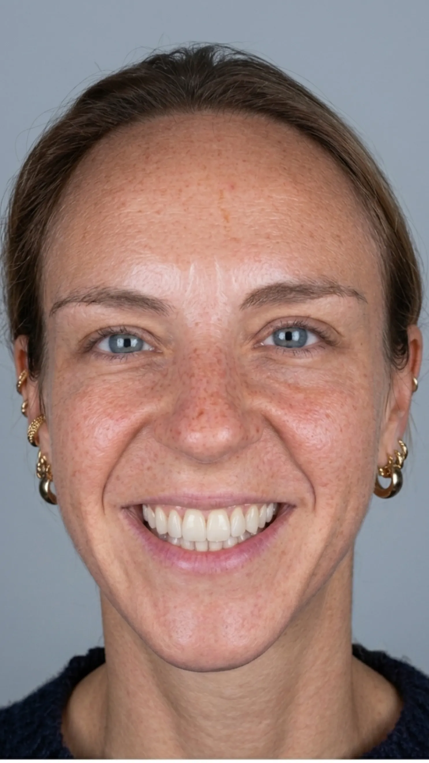 After composite bonding at Dental & Wellness London, Islington