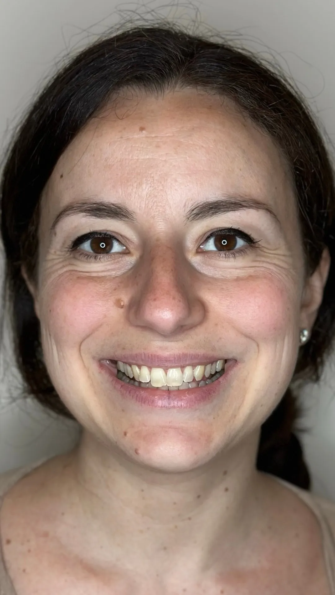Before teeth straightening at Dental & Wellness London, Islington