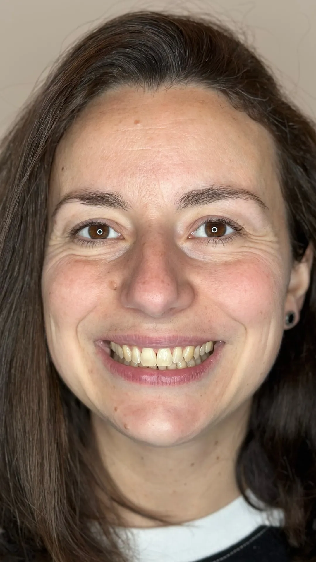After teeth straightening at Dental & Wellness London, Islington